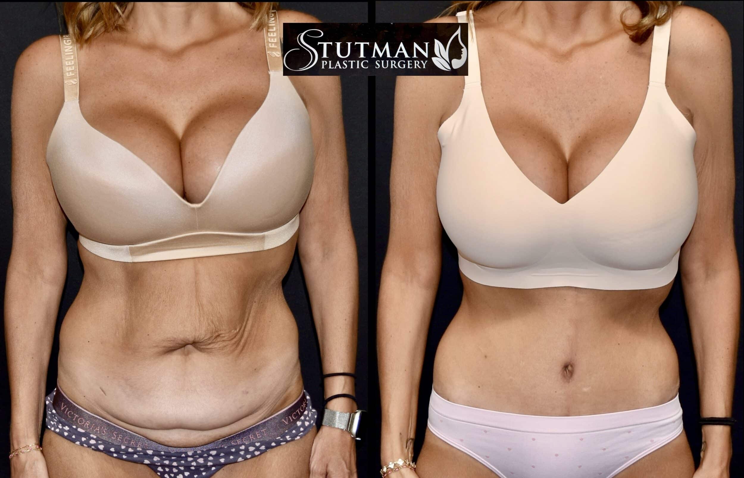 Before and After Image: Tummy Tuck - front