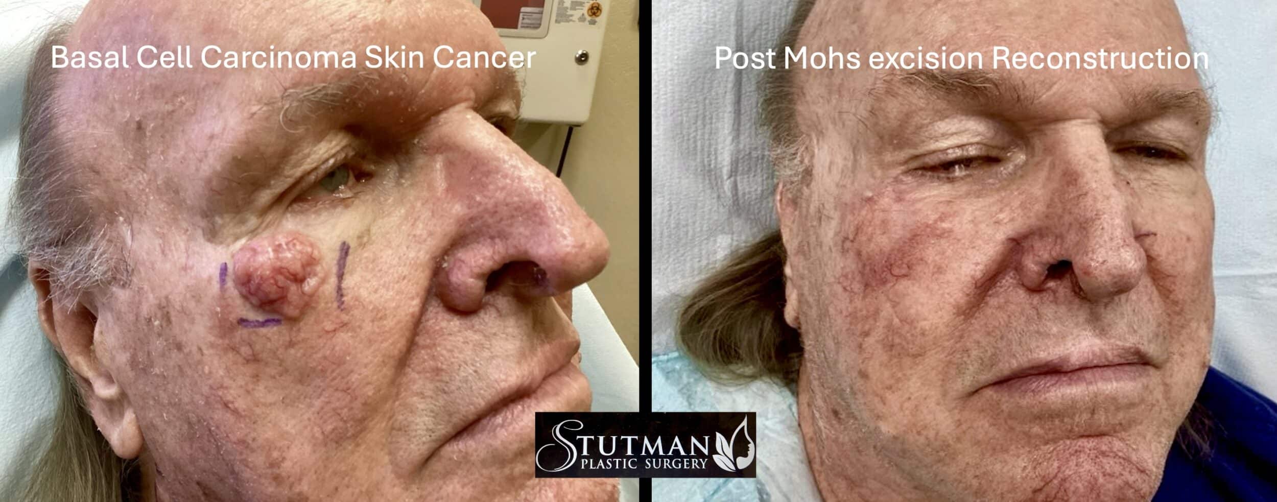 Before and After Image: Eye Skin Cancer - front
