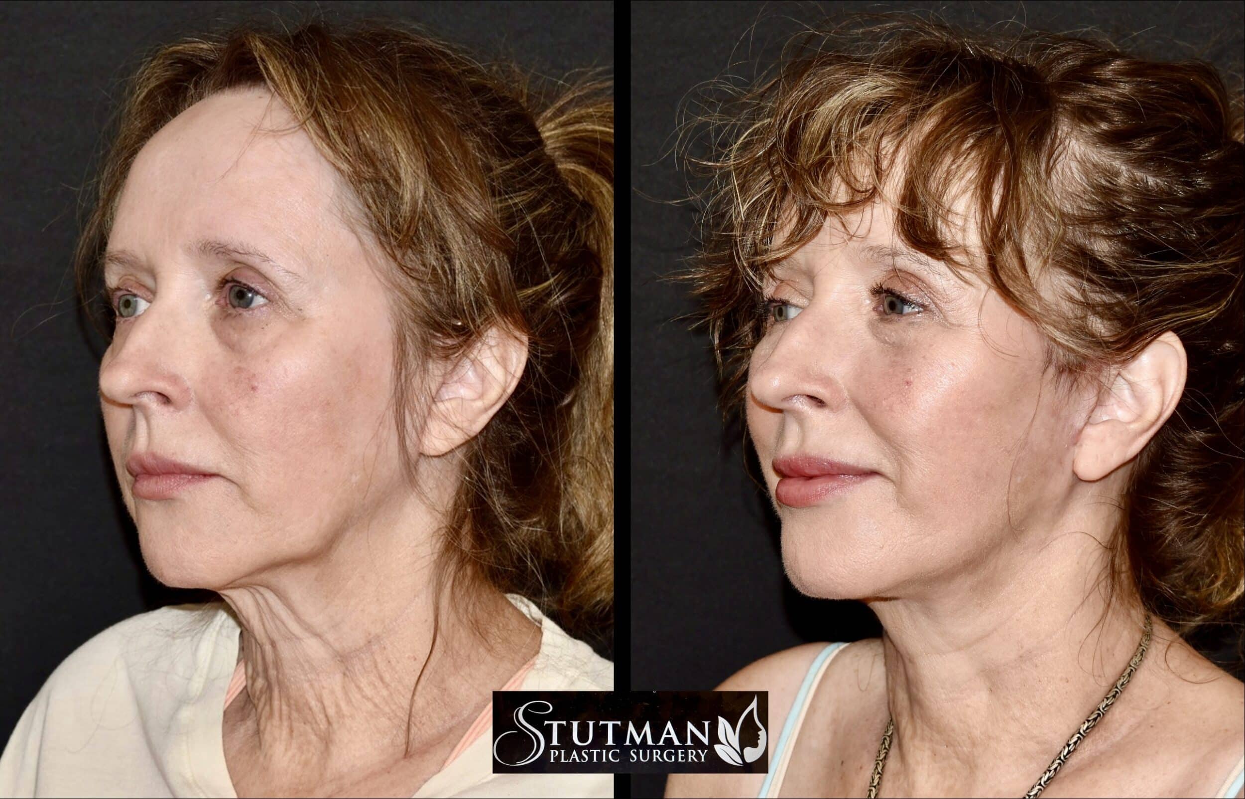 Before and After Image: Facelift / Necklift - left-front-oblique