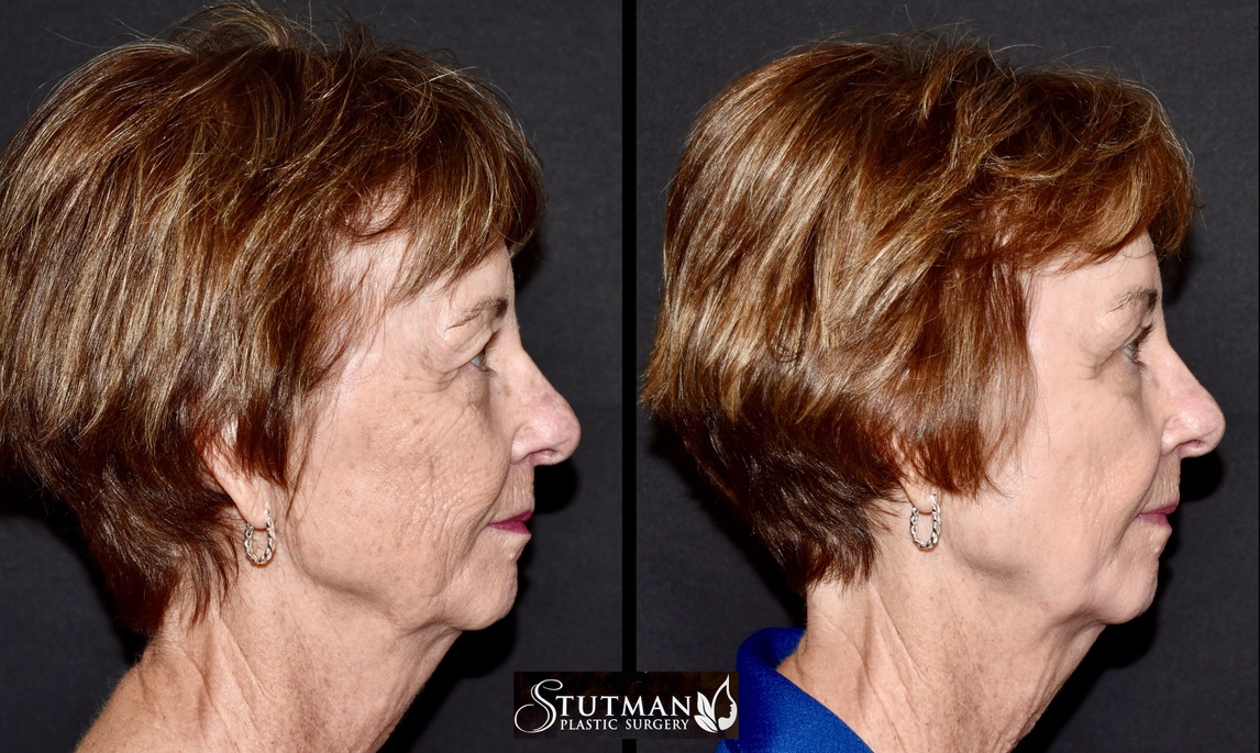 Before and After Image: Chemical Peel - right-side