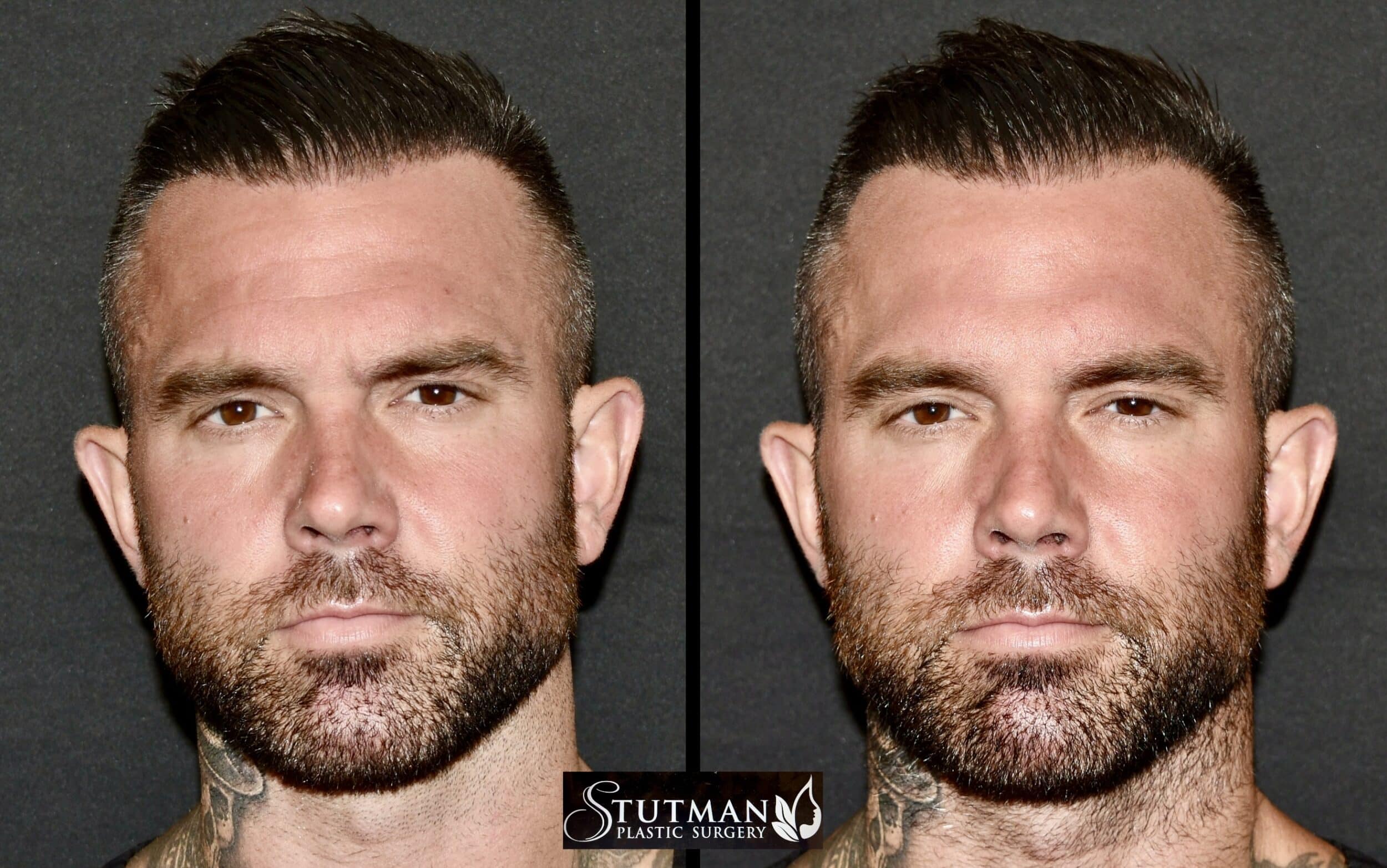 Before and After Image: Botox - front