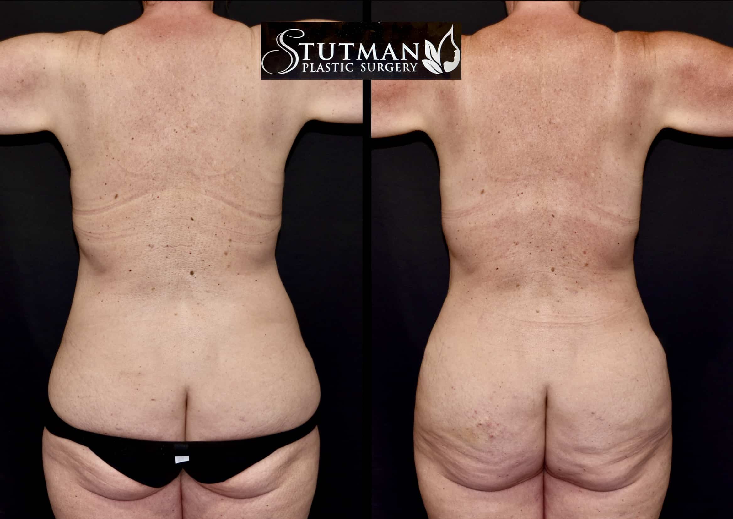 Before and After Image: Tummy Tuck - back