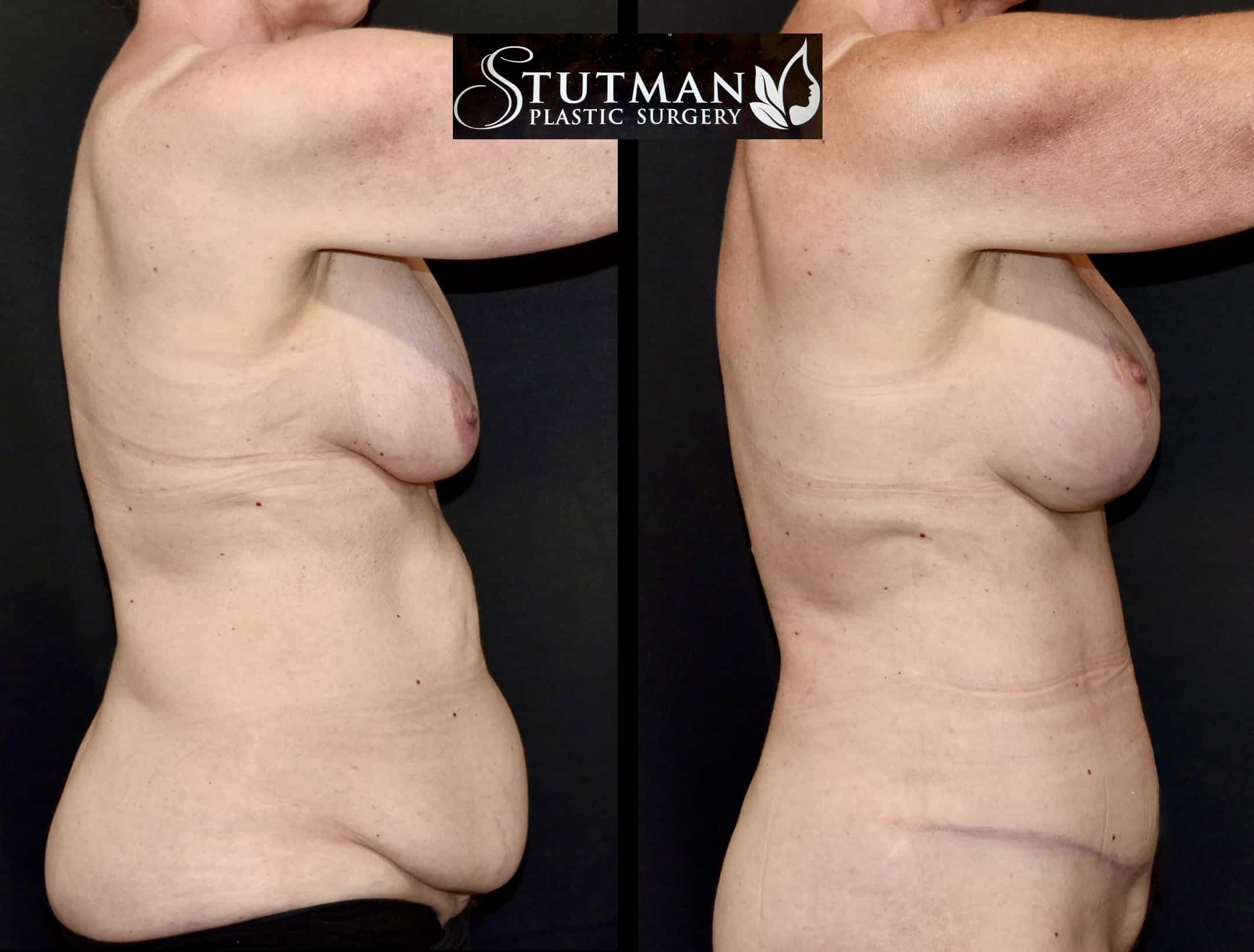 Before and After Image: Tummy Tuck - right-side