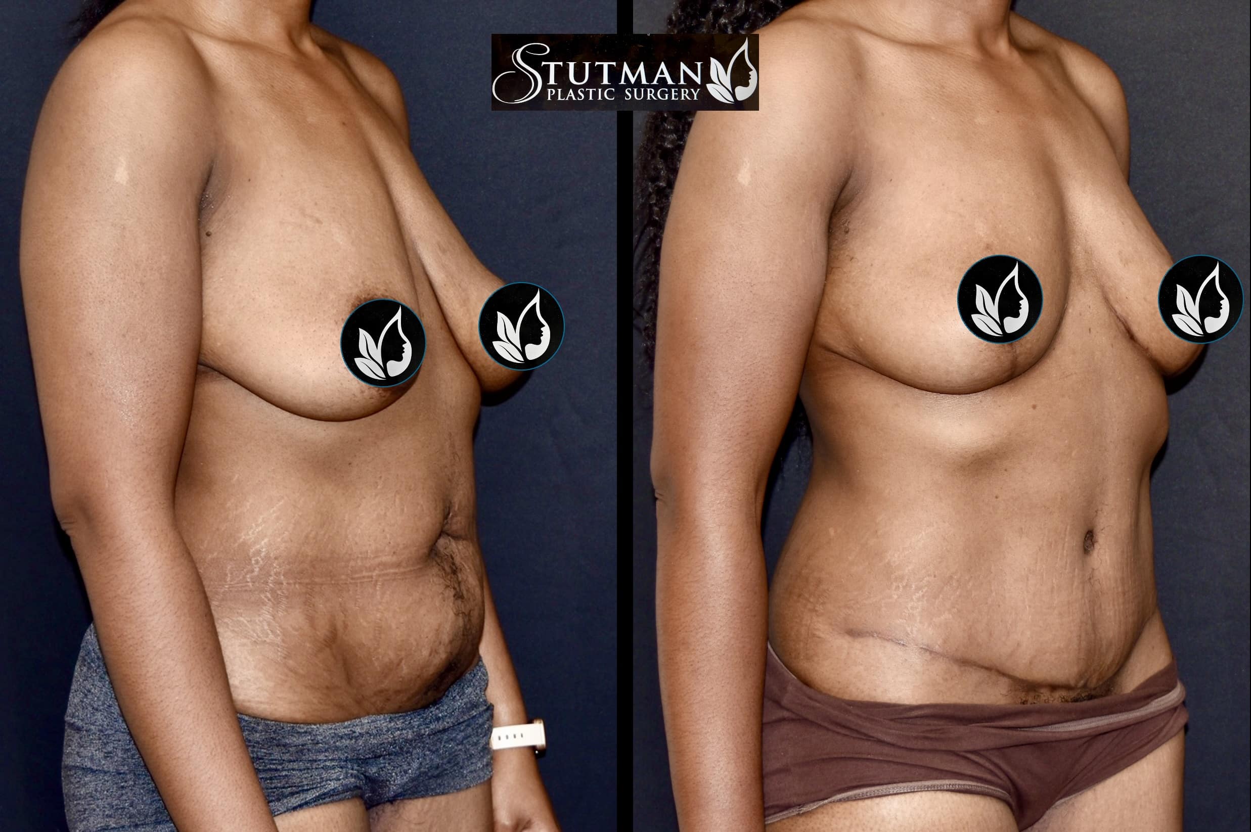 Before and After Image: Tummy Tuck - right-front-oblique