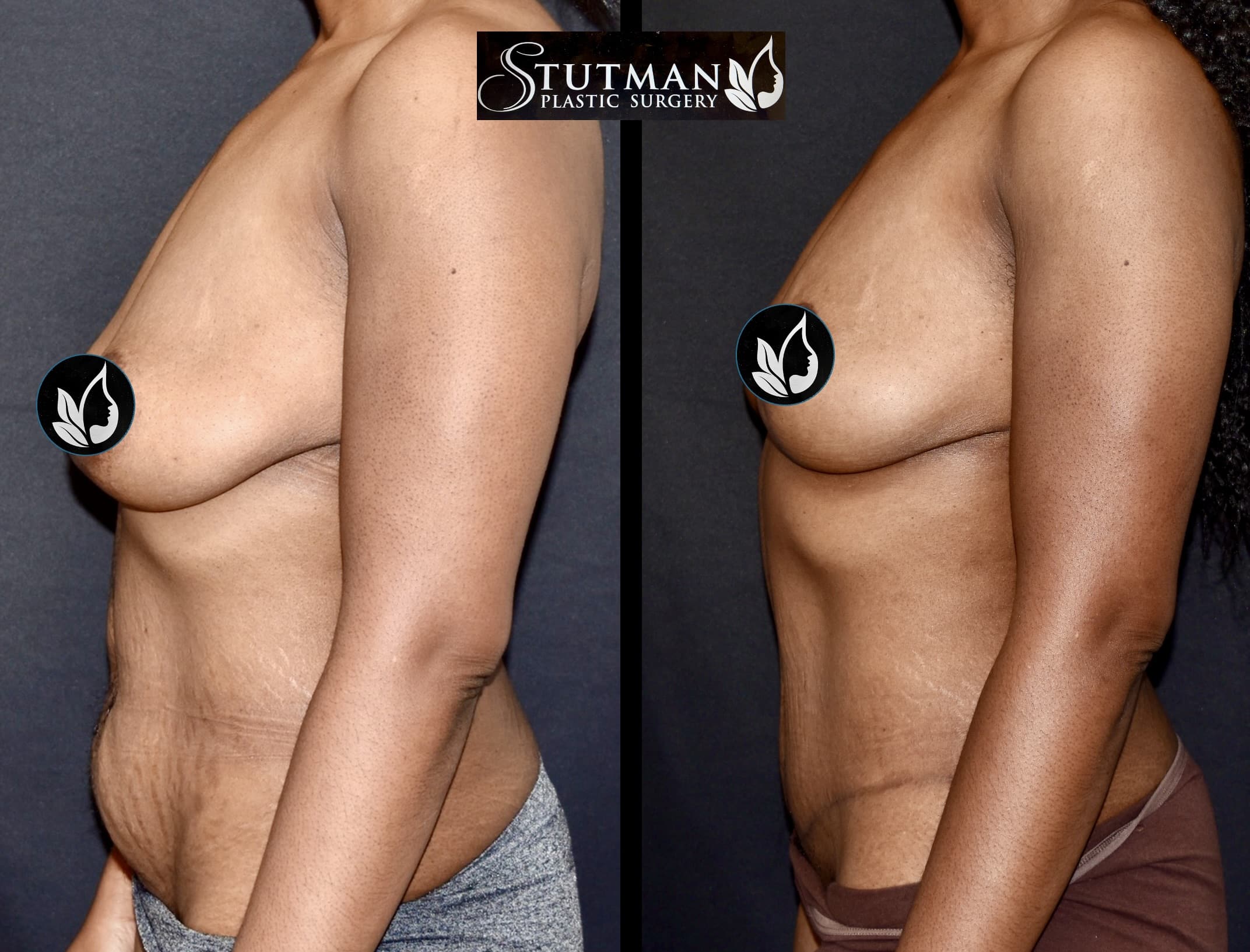 Before and After Image: Tummy Tuck - left-side