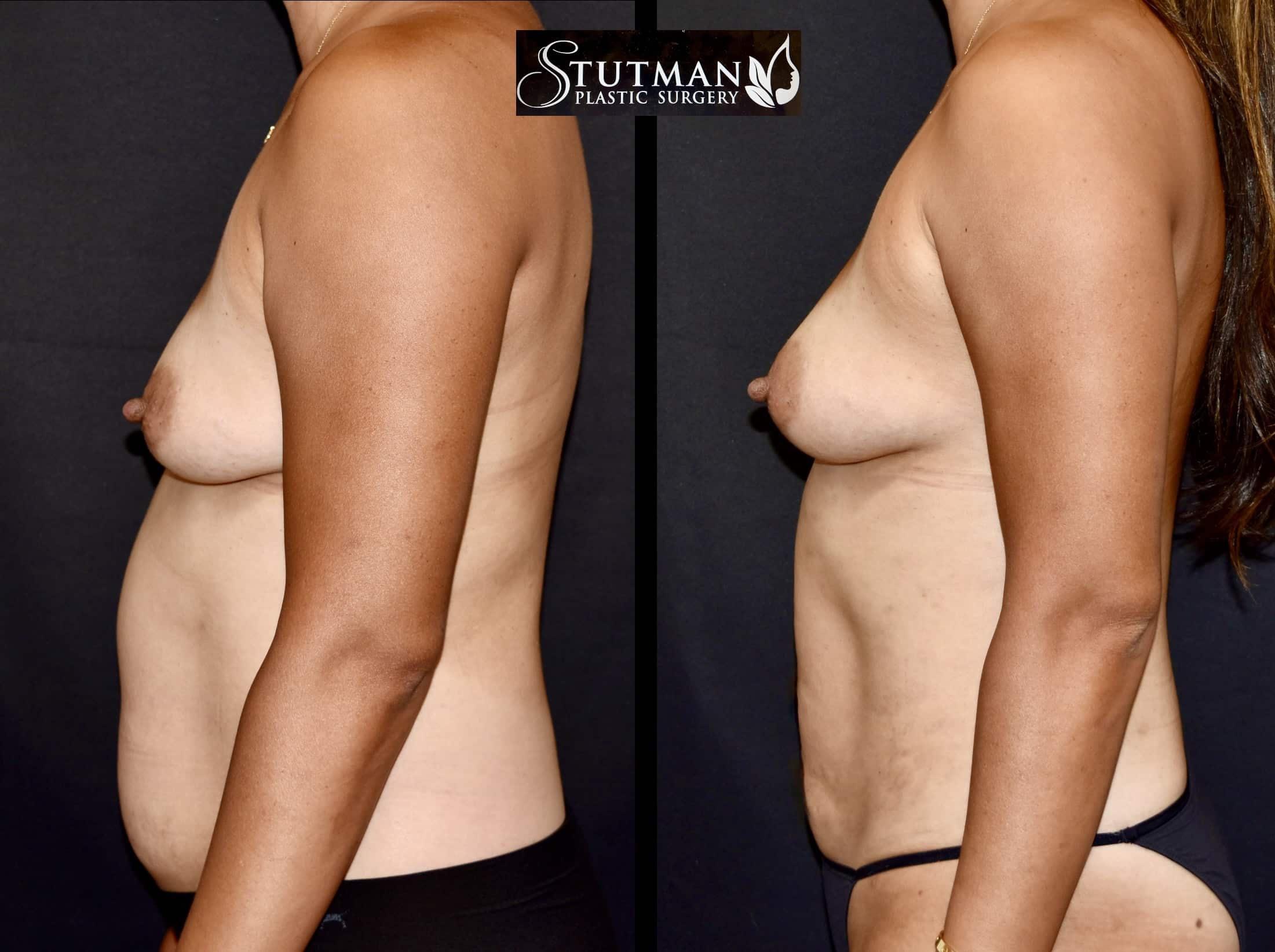 Before and After Image: High-Def Liposuction - left-side
