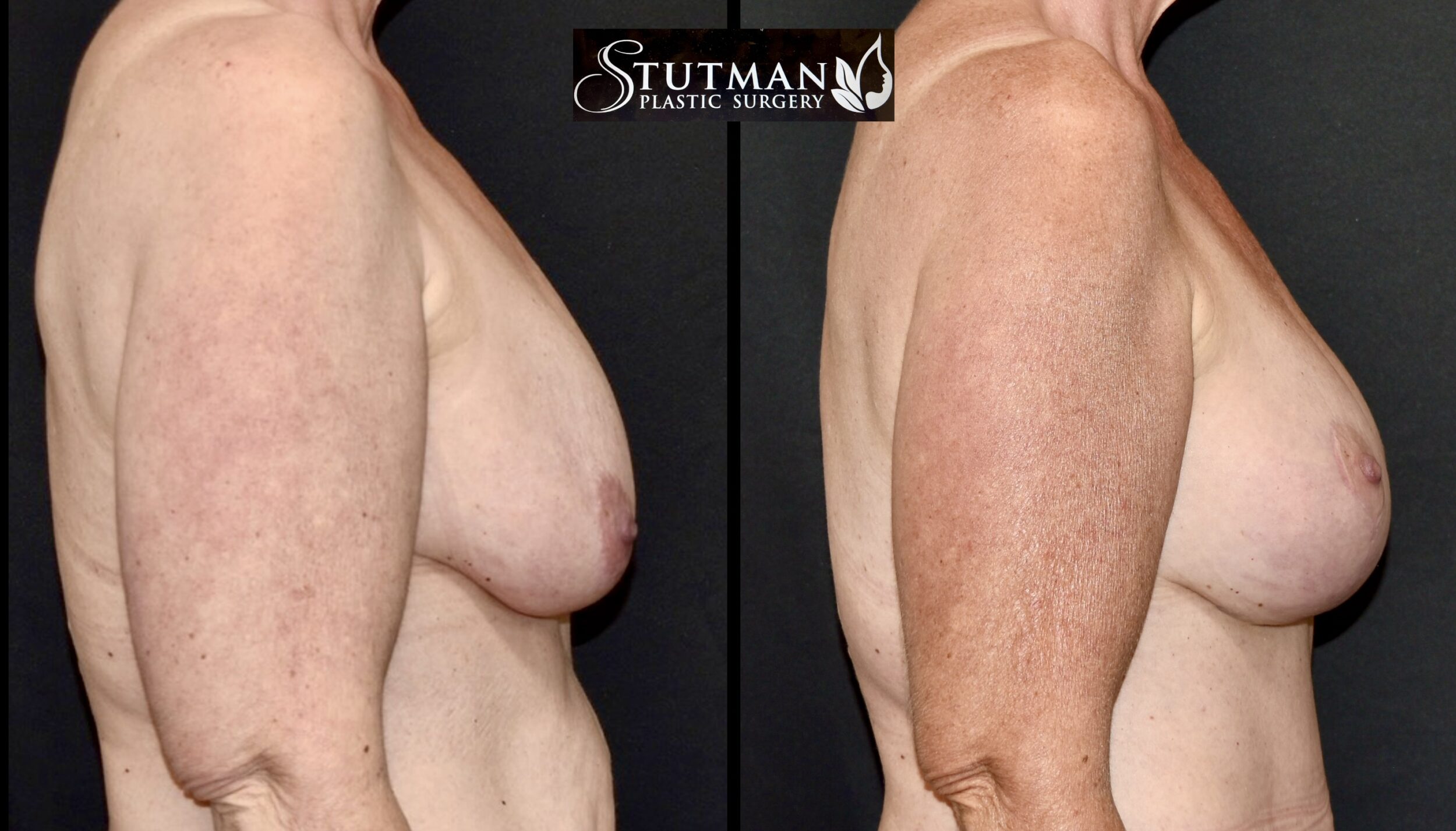 Before and After Image: Breast augmentation with Mastopexy - right-side