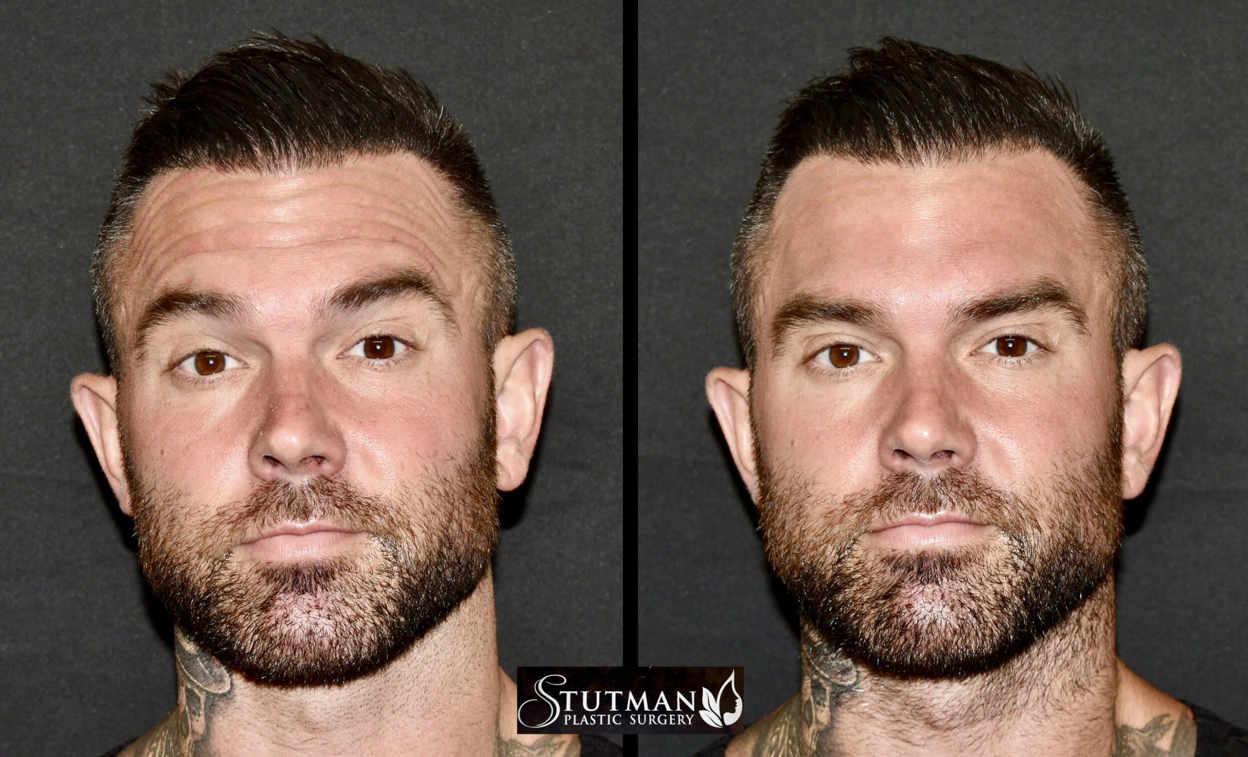 Before and After Image: Botox - front
