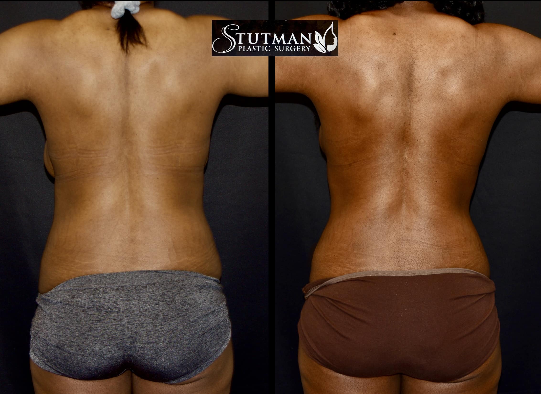 Before and After Image: Tummy Tuck - back