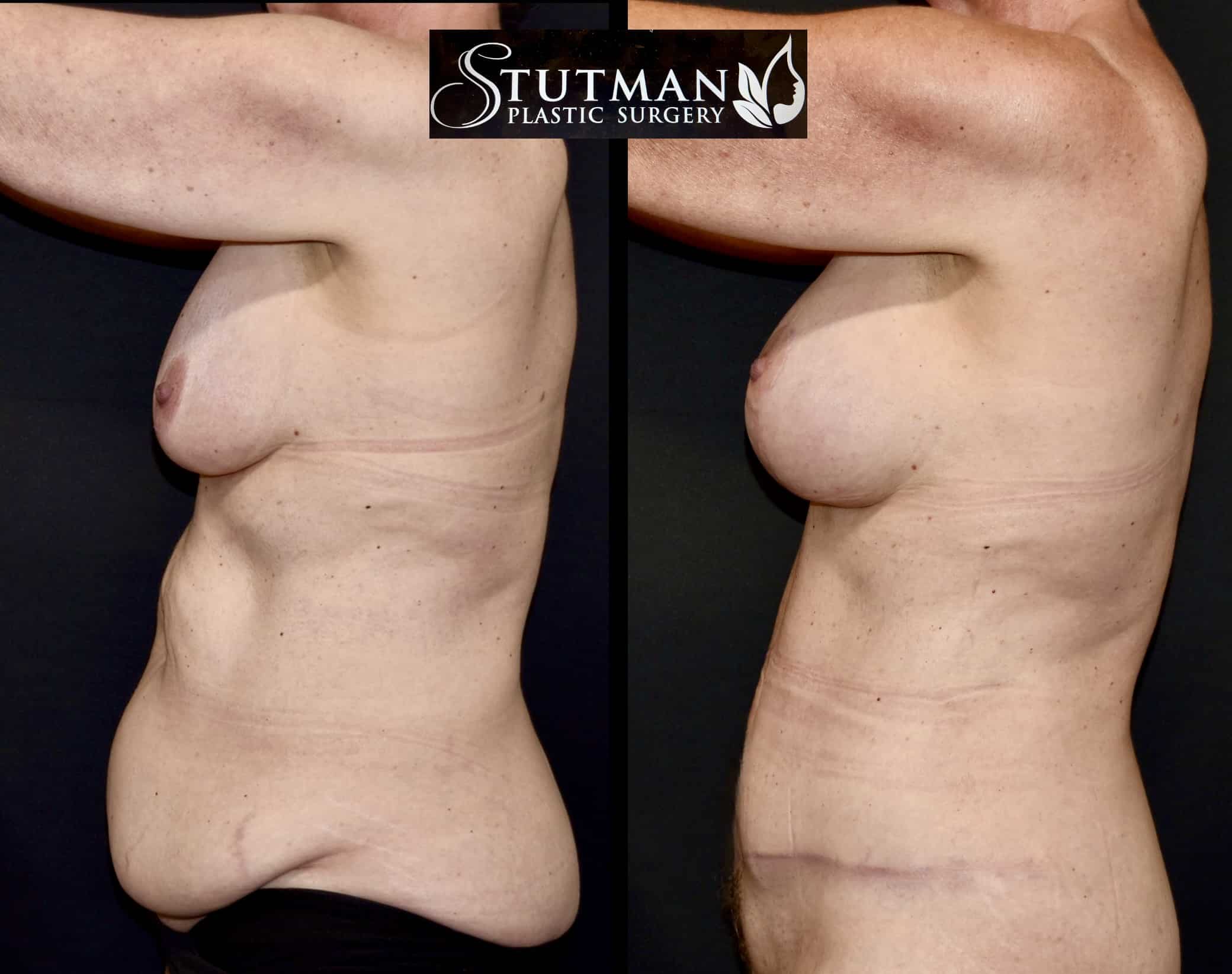 Before and After Image: Tummy Tuck - left-side