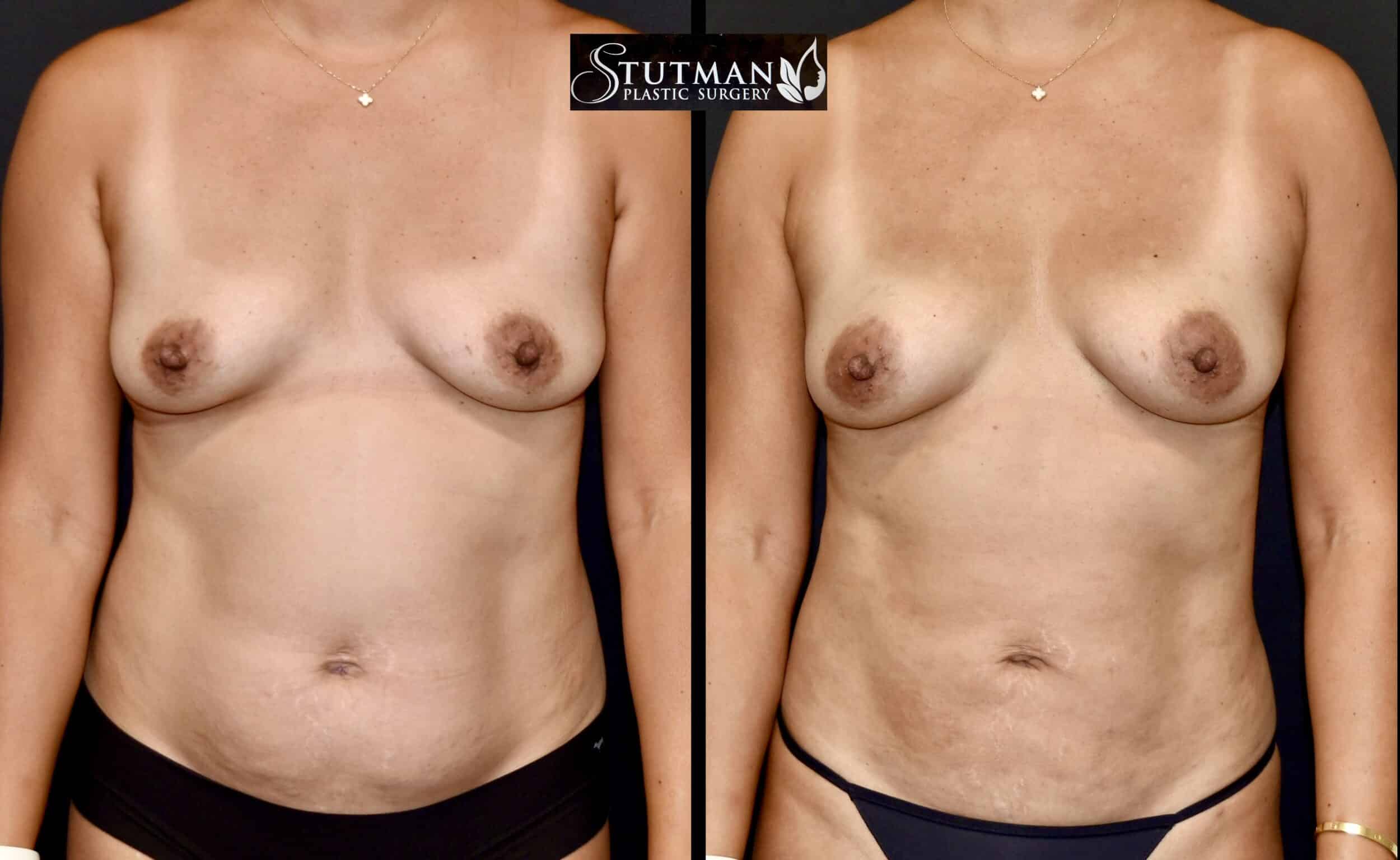 Before and After Image: High-Def Liposuction - front
