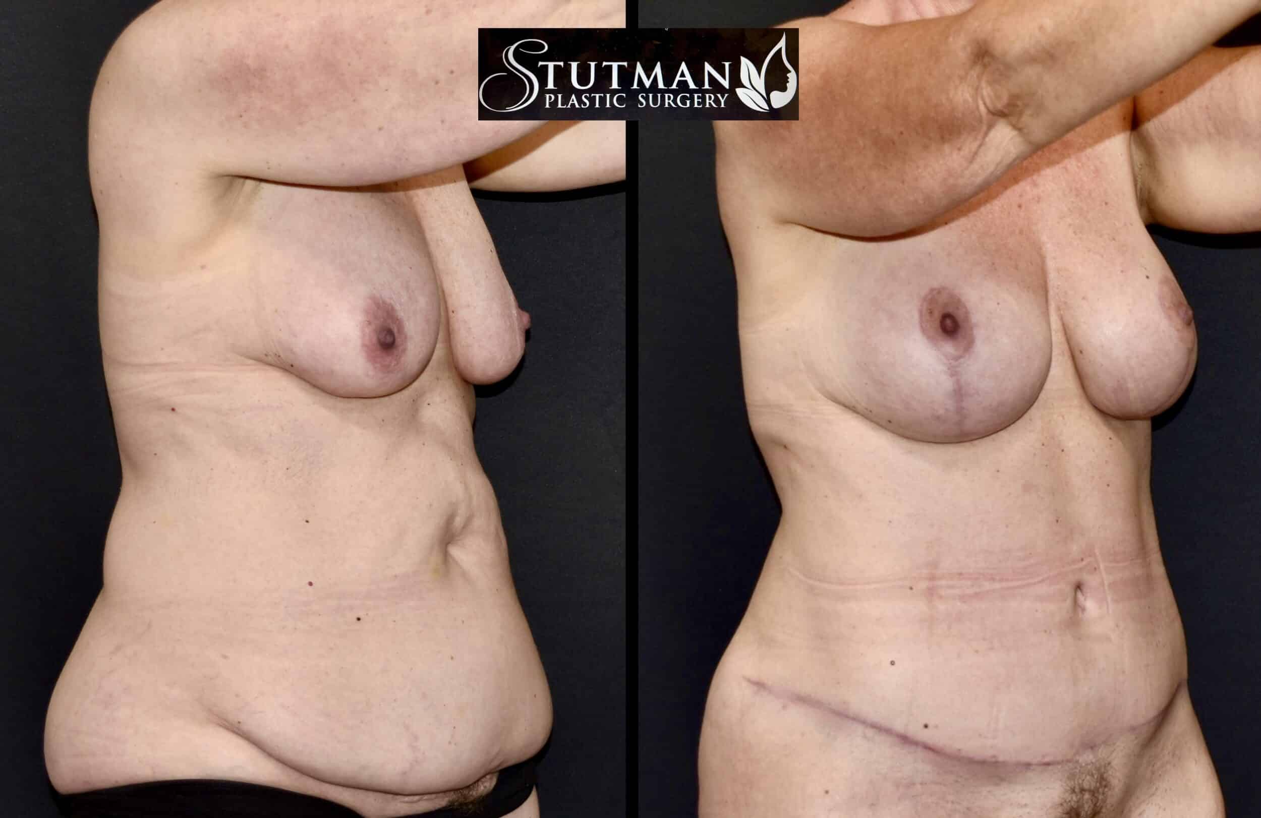 Before and After Image: Tummy Tuck - right-front-oblique
