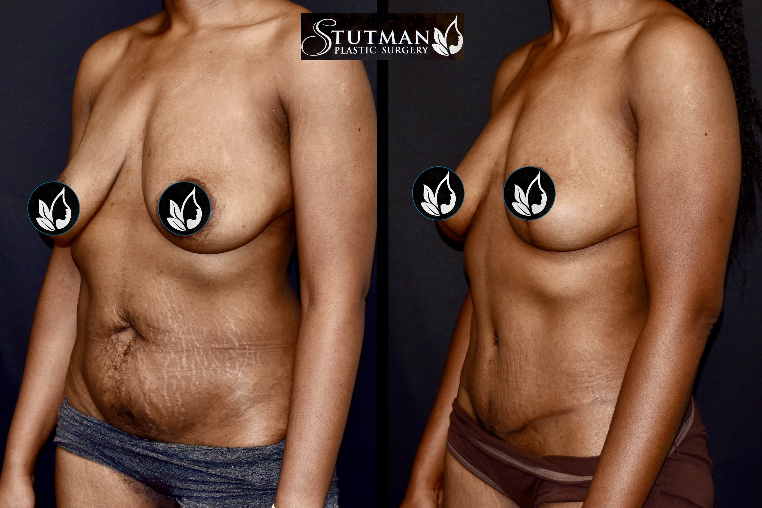 Before and After Image: Tummy Tuck - left-front-oblique
