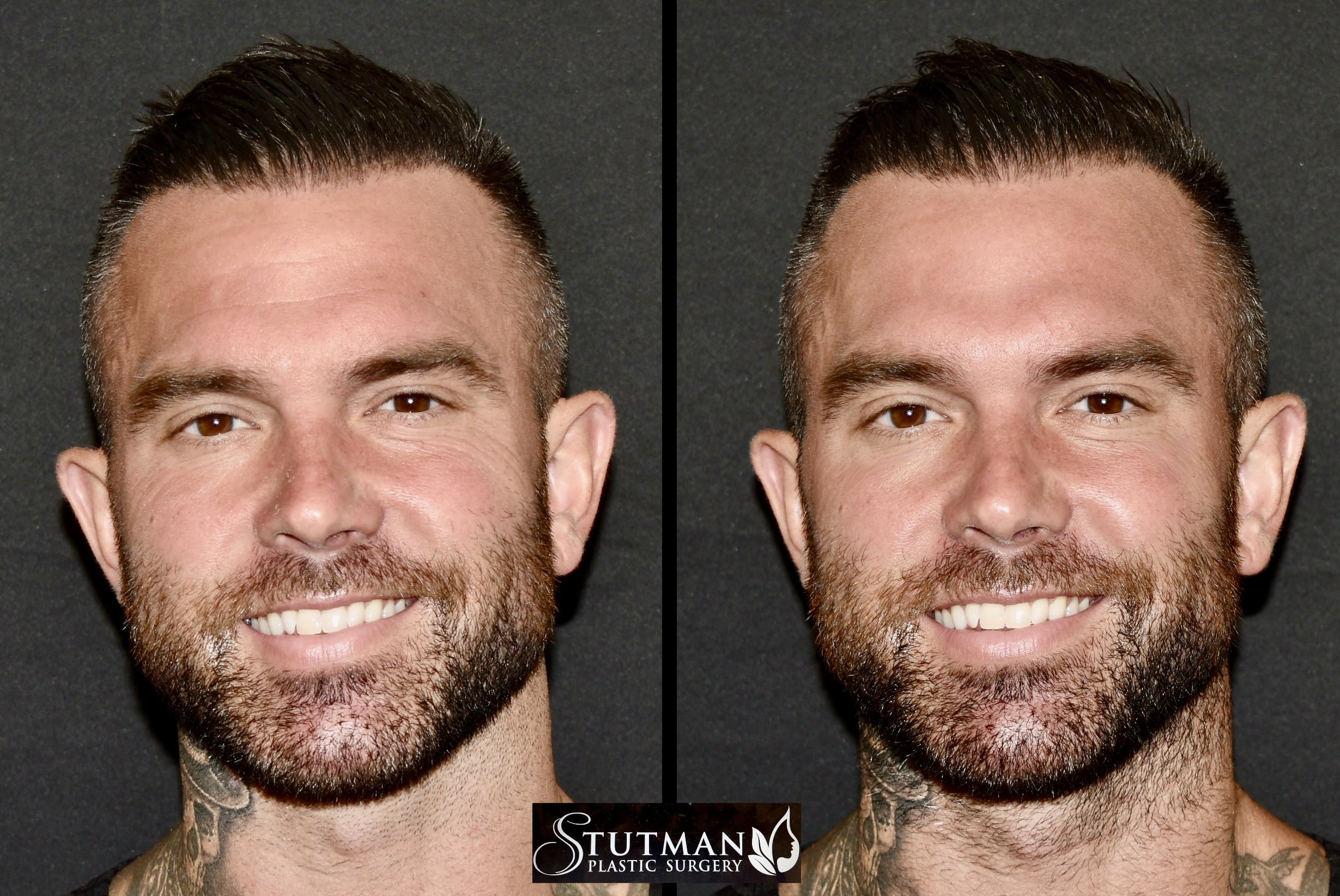 Before and After Image: Botox - front
