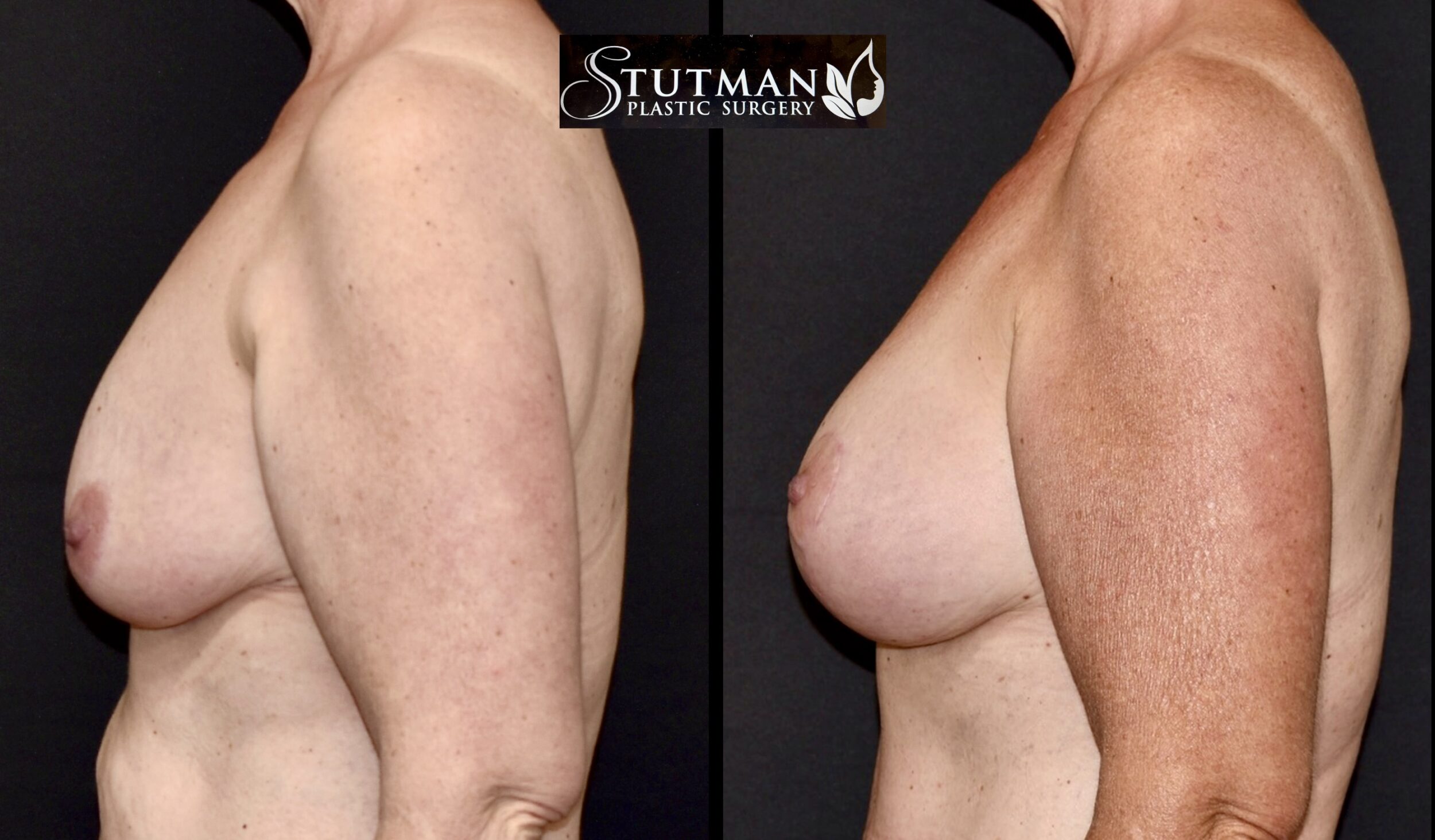 Before and After Image: Breast augmentation with Mastopexy - 