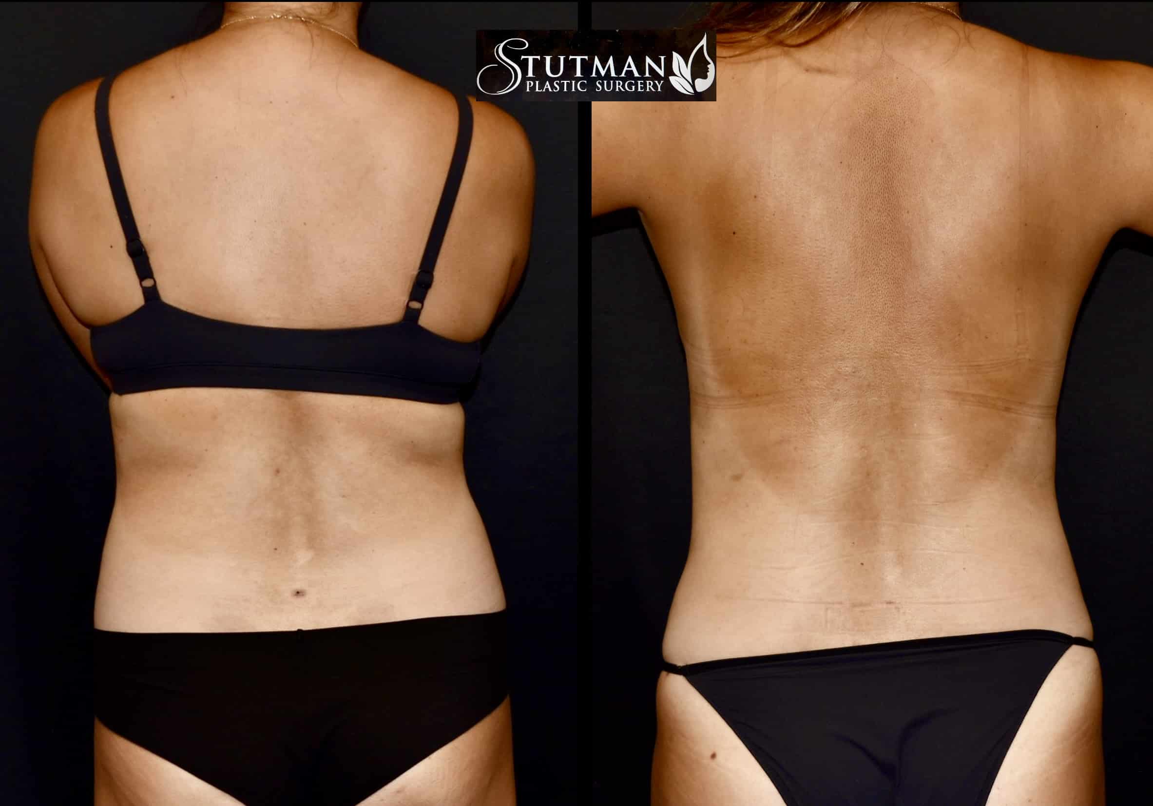 Before and After Image: High-Def Liposuction - back