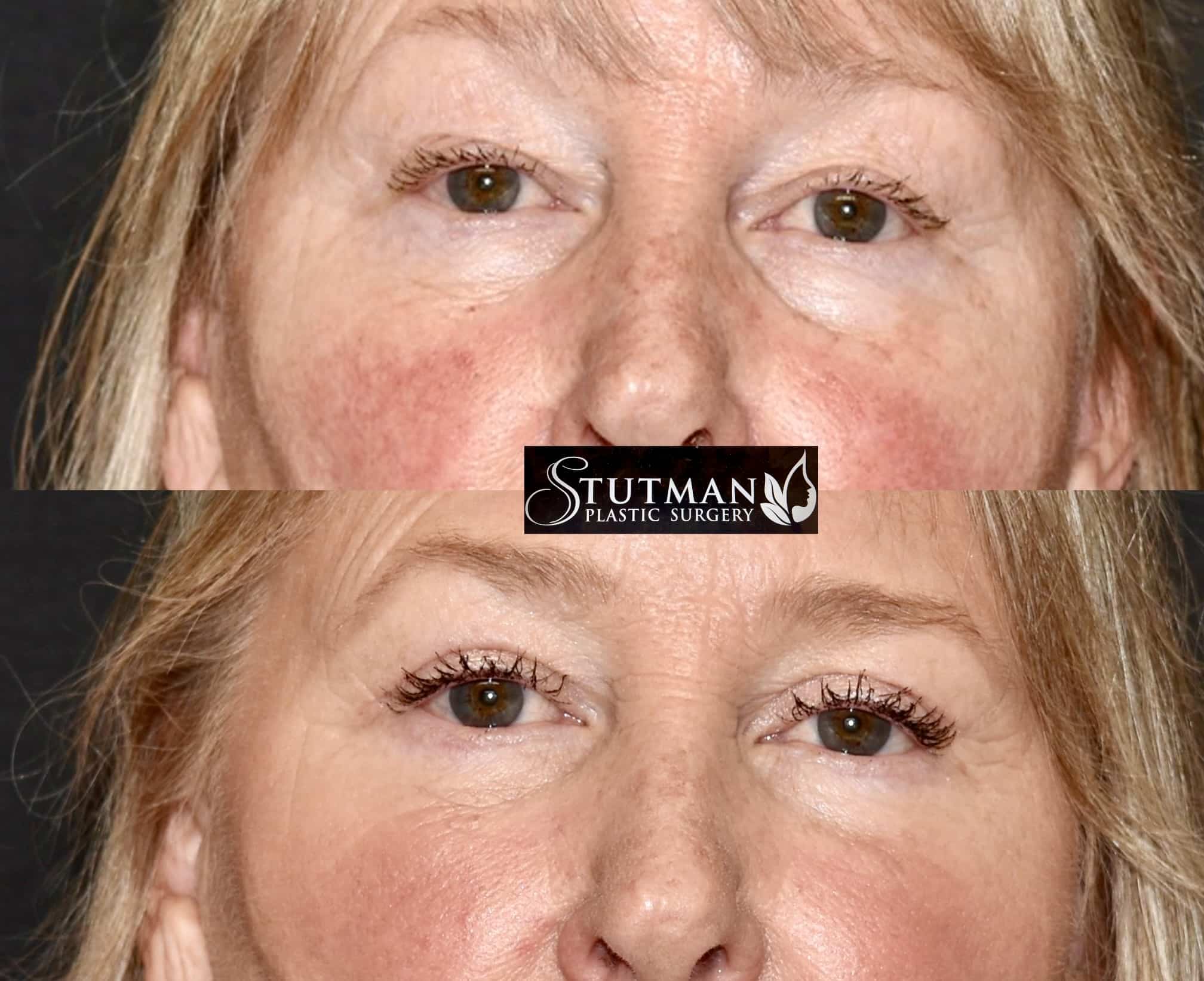 Before and After Image: Blepharoplasty - front