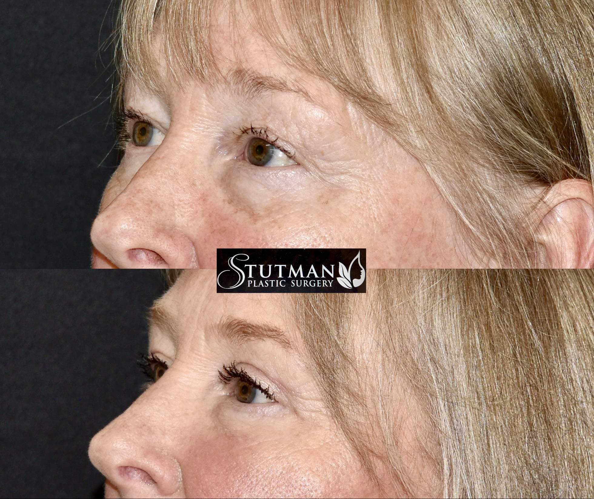 Before and After Image: Blepharoplasty - left-front-oblique