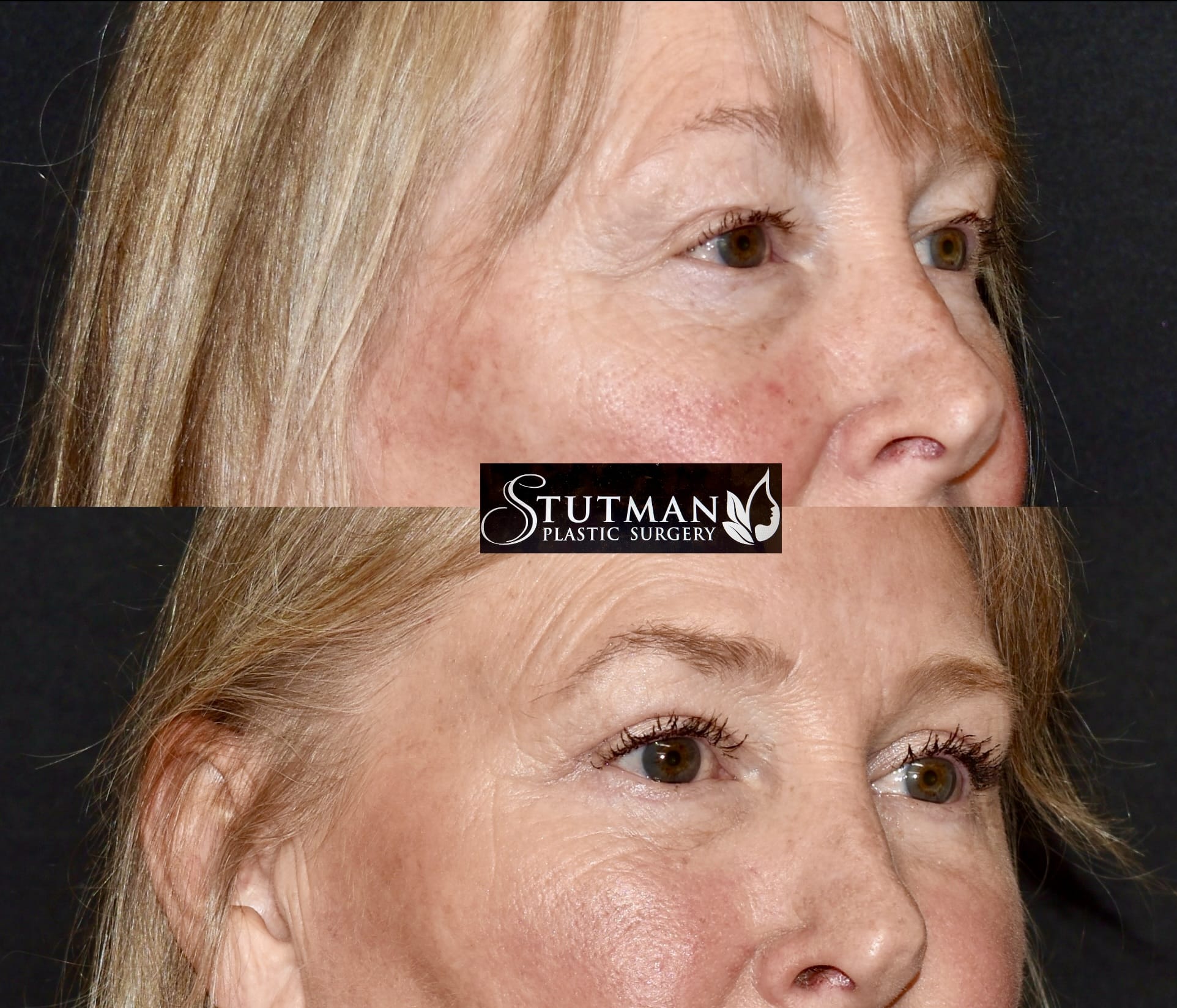 Before and After Image: Blepharoplasty - right-front-oblique