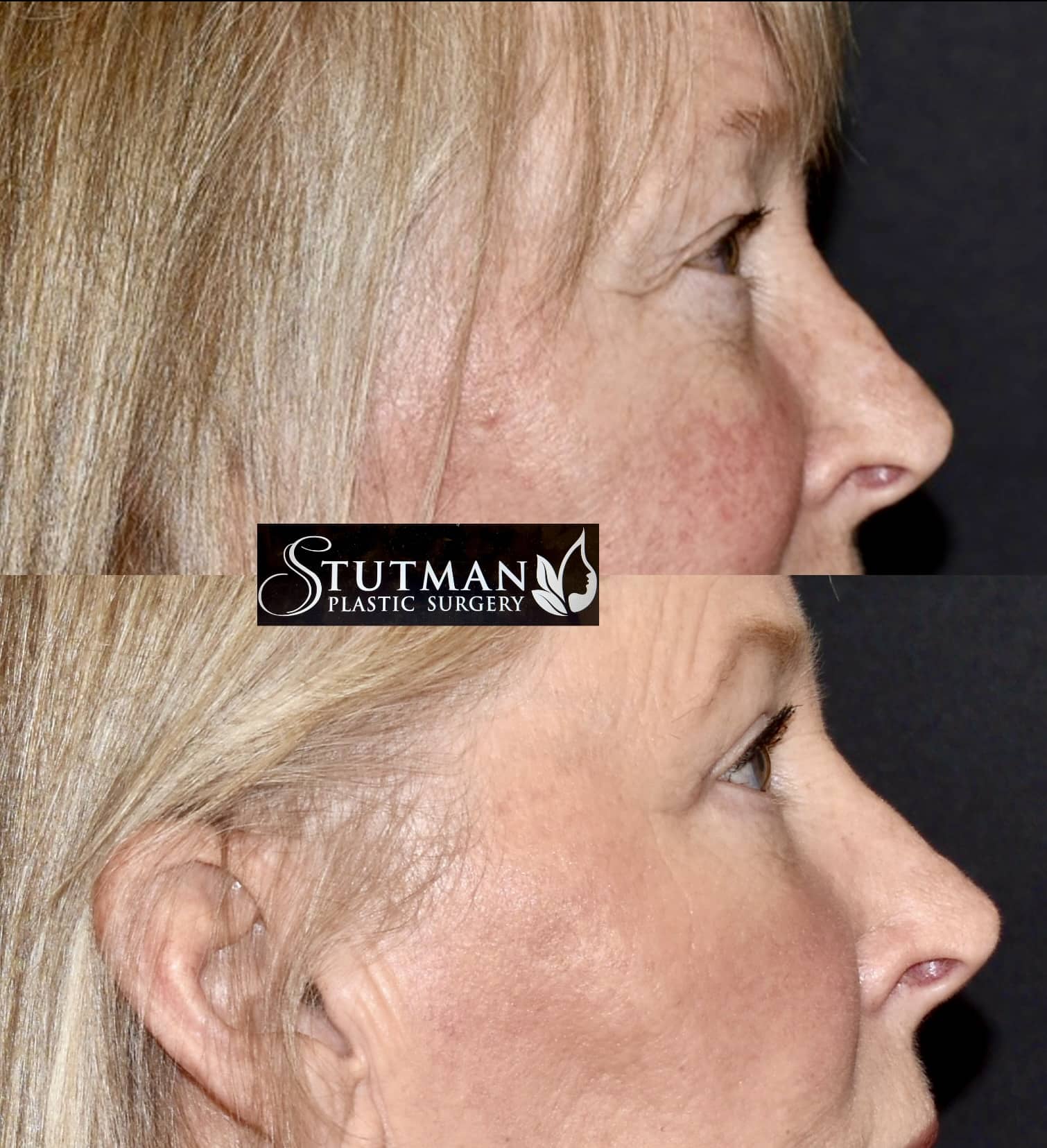 Before and After Image: Blepharoplasty - right-side