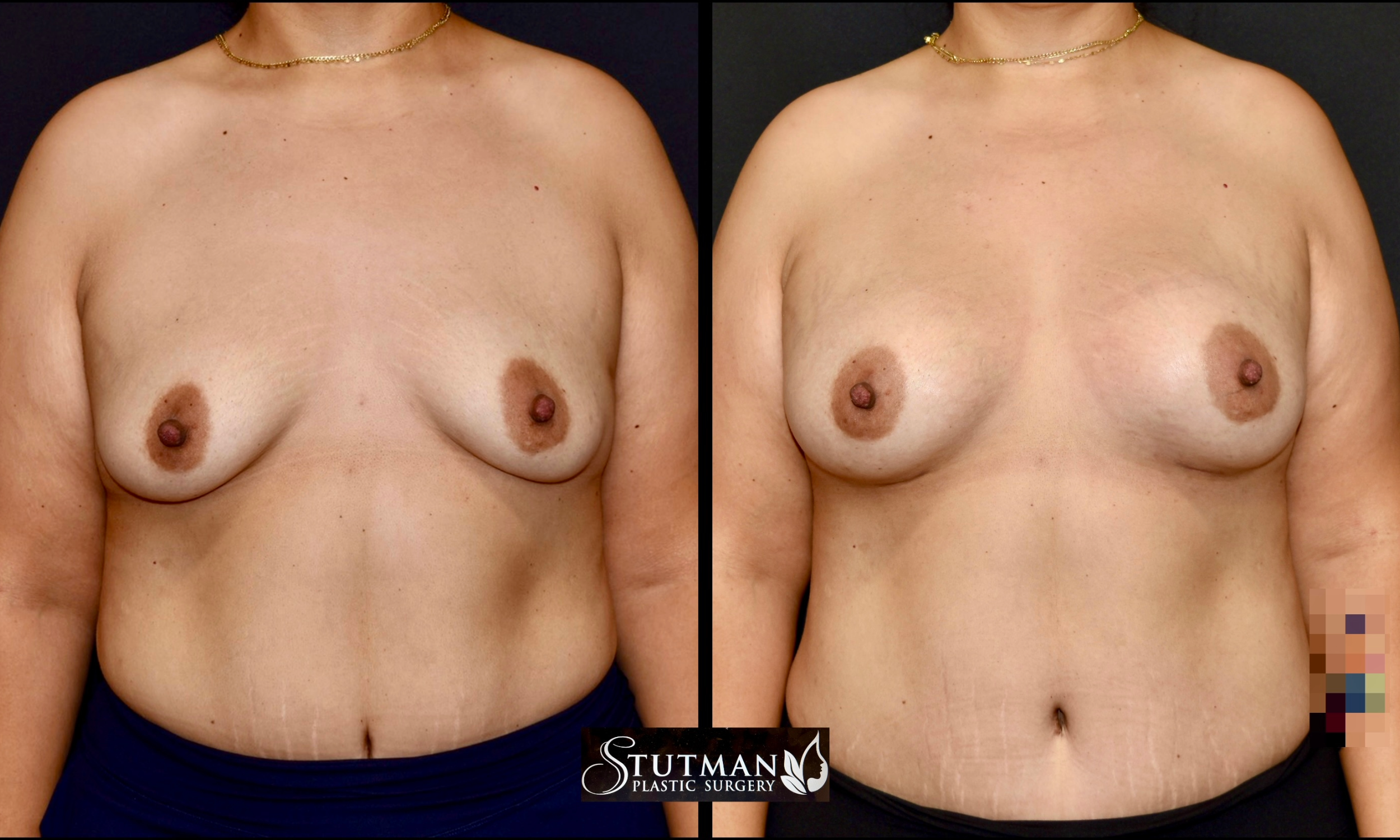 Before and After Image: Breast Augmentation