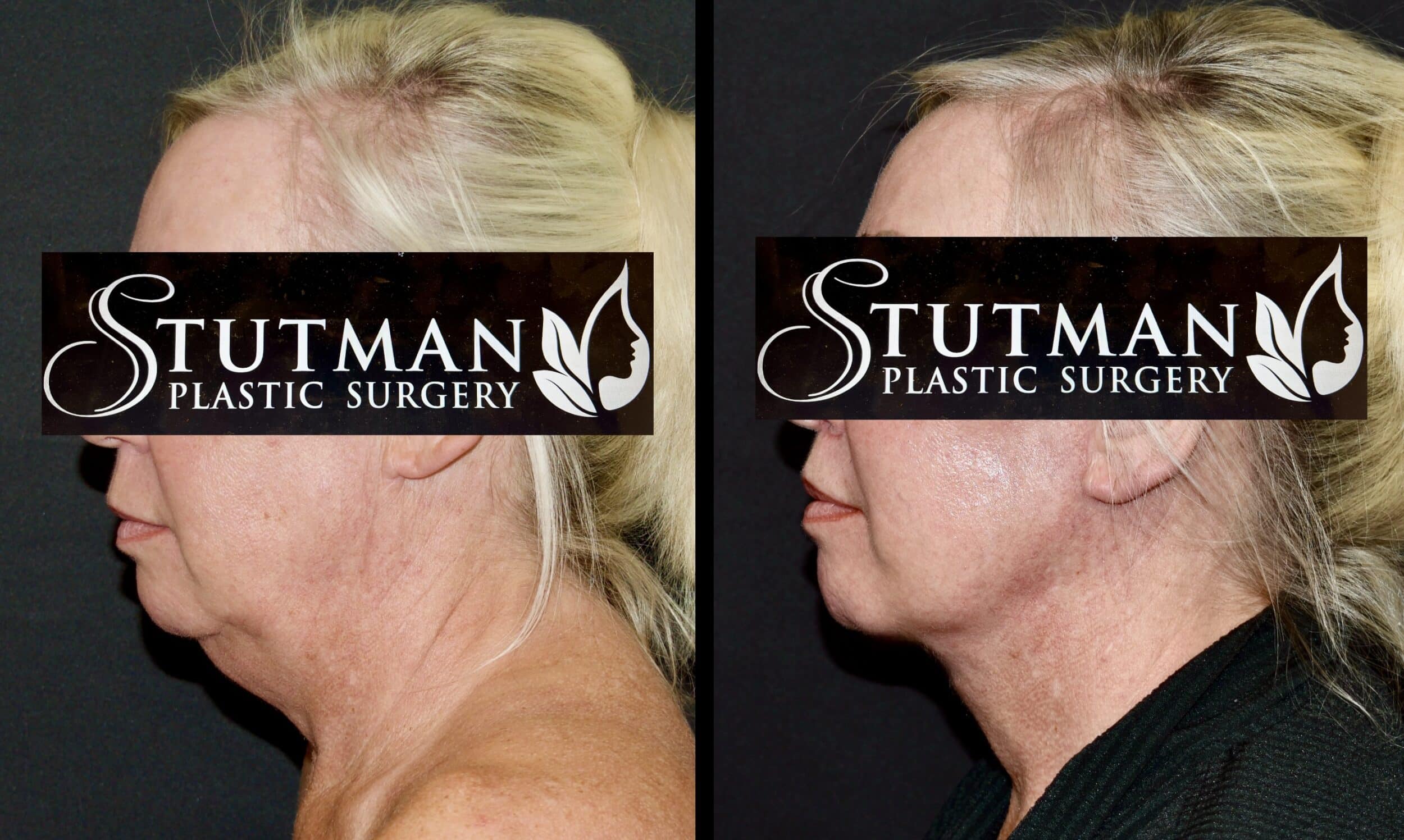 Before and After Image: Facelift / Necklift - left-side