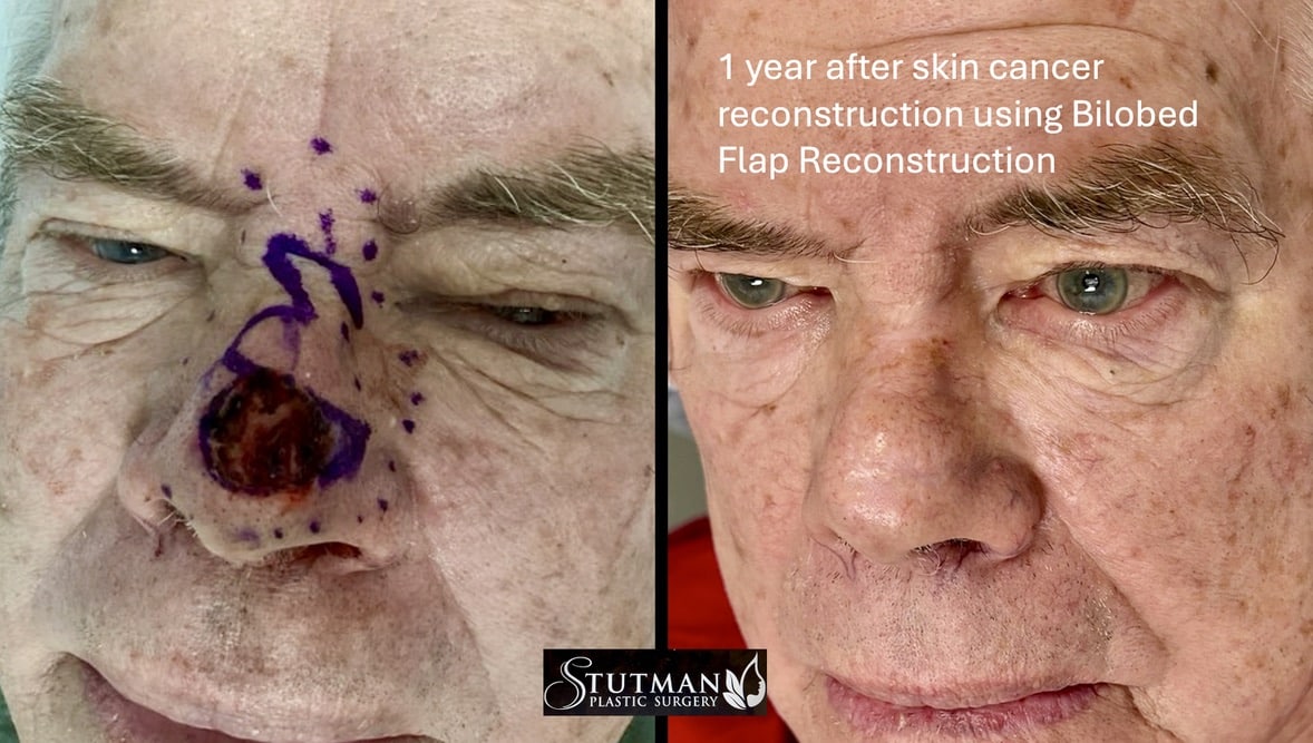 Before and After Image: Nose skin cancer