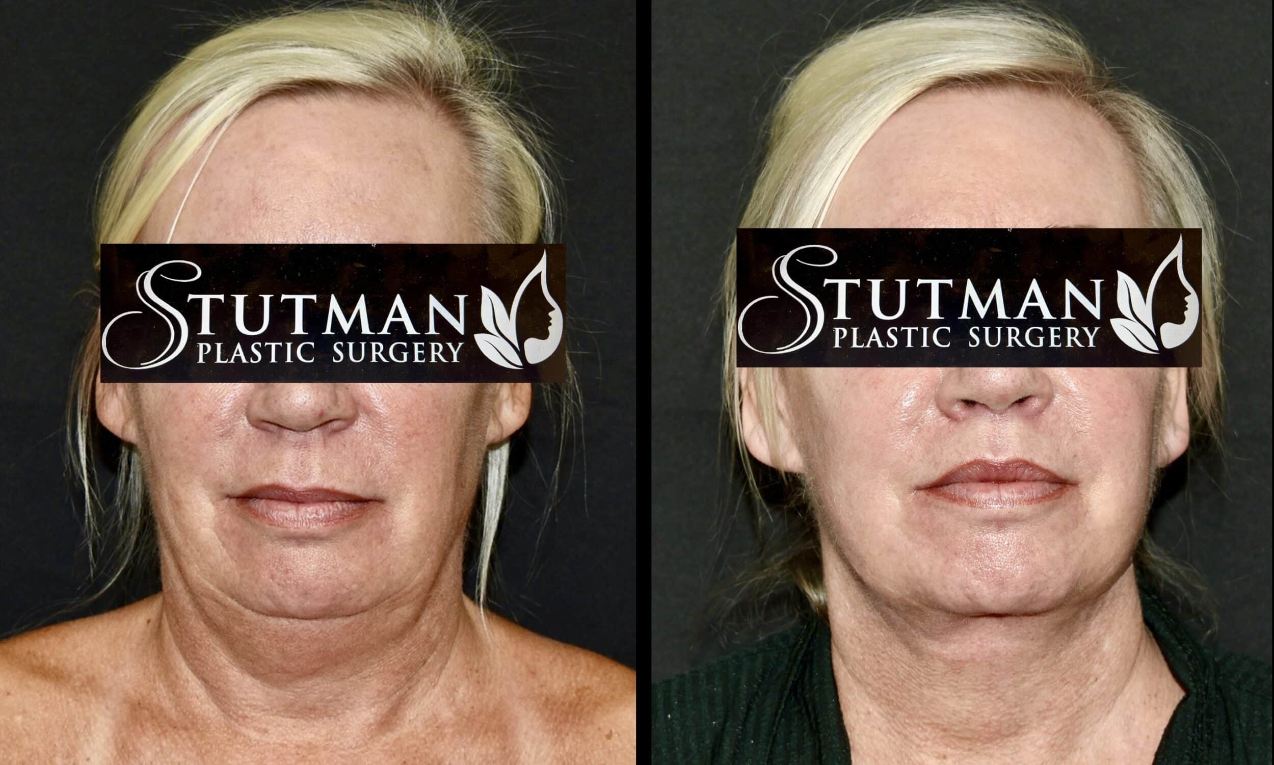 Before and After Image: Facelift / Necklift - front