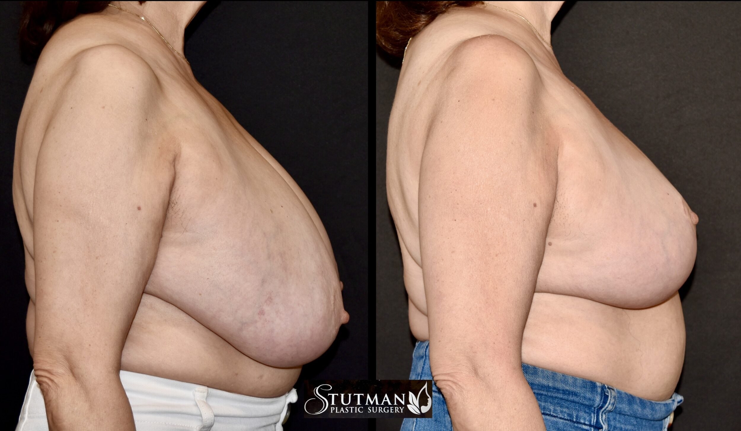 Before and After Image: Breast Reduction - right-side