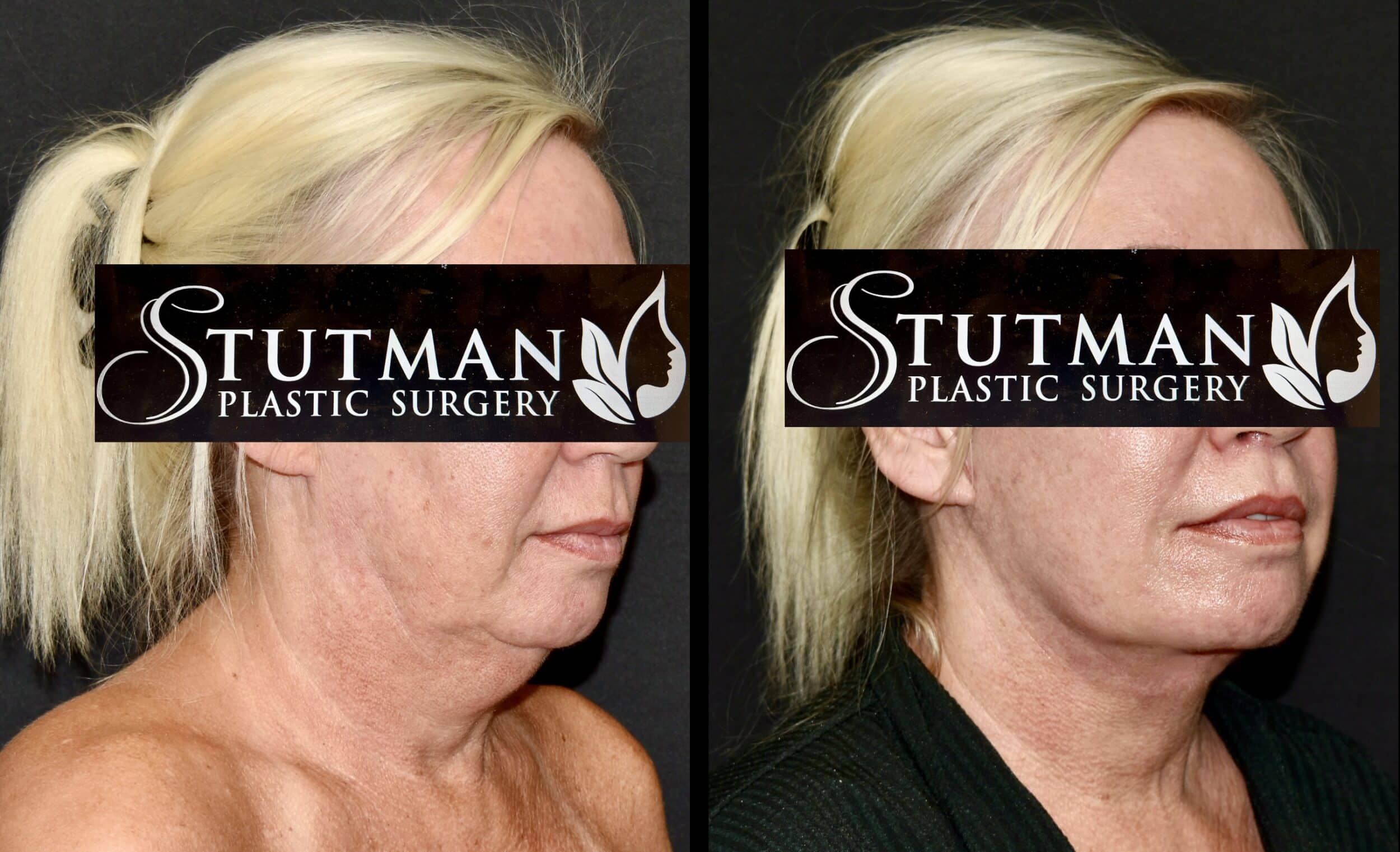 Before and After Image: Facelift / Necklift - right-front-oblique