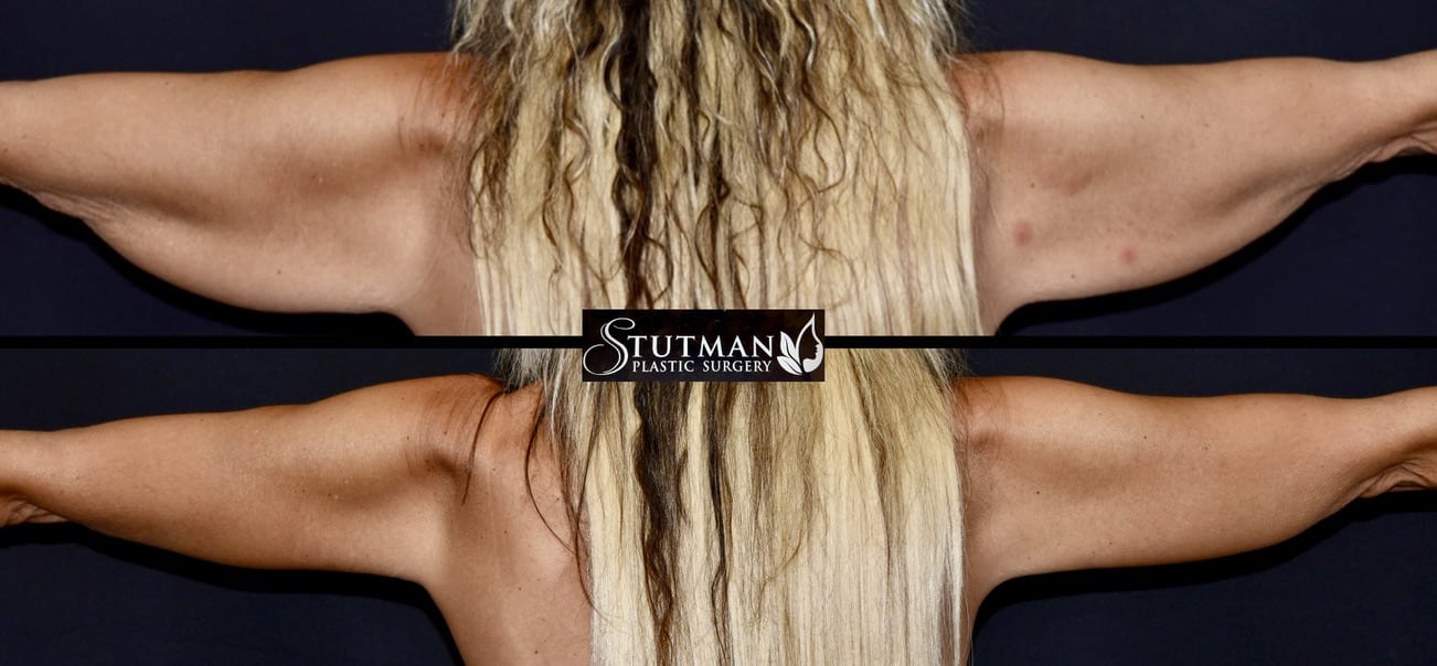 Before and After Image: Brachioplasty - back