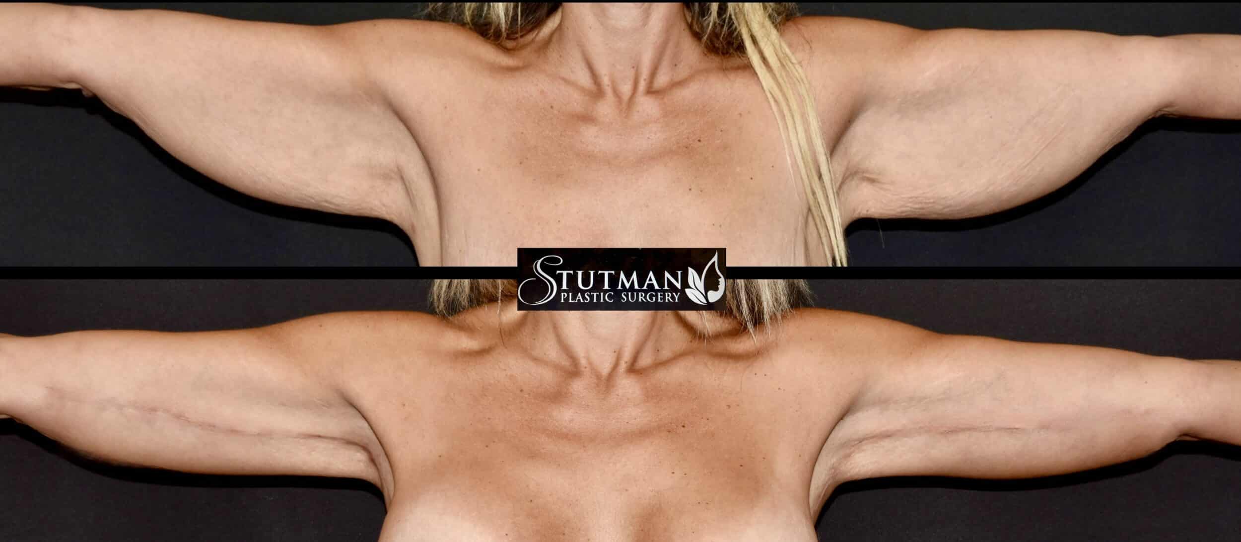 Before and After Image: Brachioplasty - front