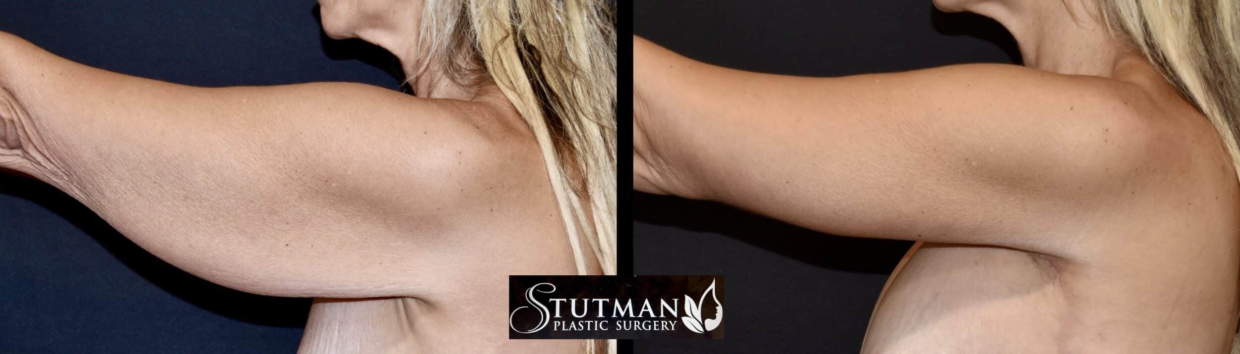 Before and After Image: Brachioplasty - left-side