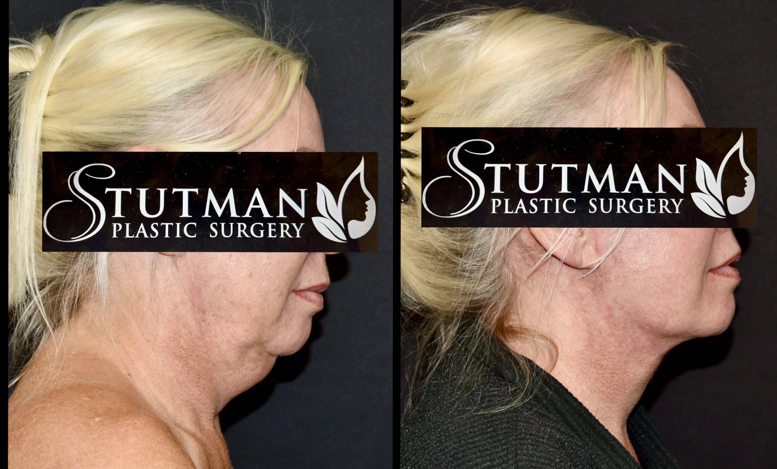Before and After Image: Facelift / Necklift - right-side