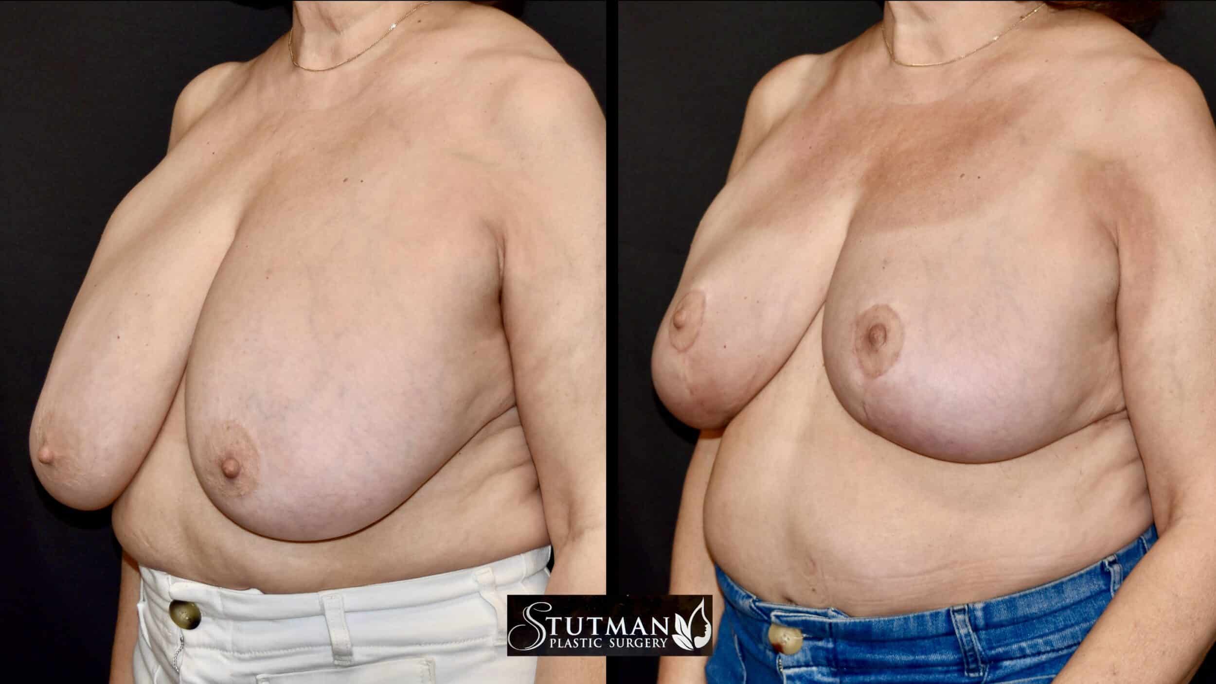 Before and After Image: Breast Reduction - left-front-oblique