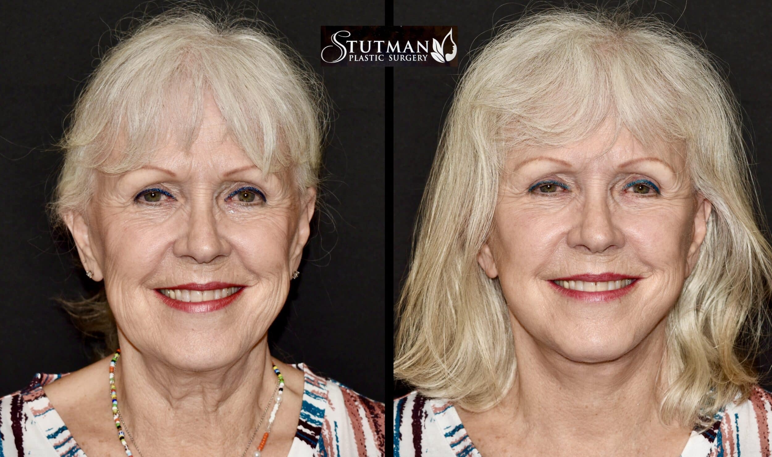 Before and After Image: Facelift/Necklift - front