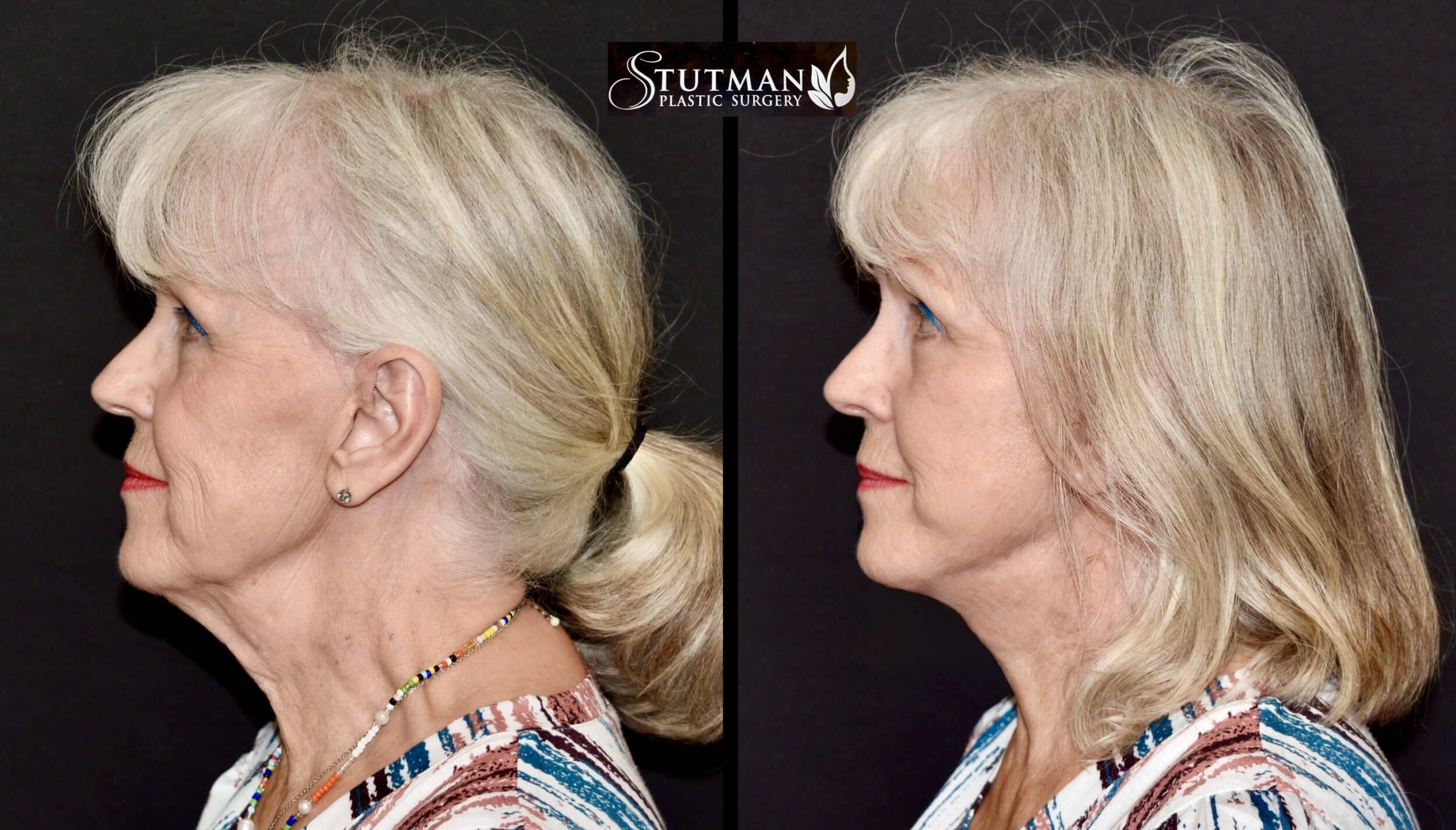 Before and After Image: Facelift/Necklift - left-side