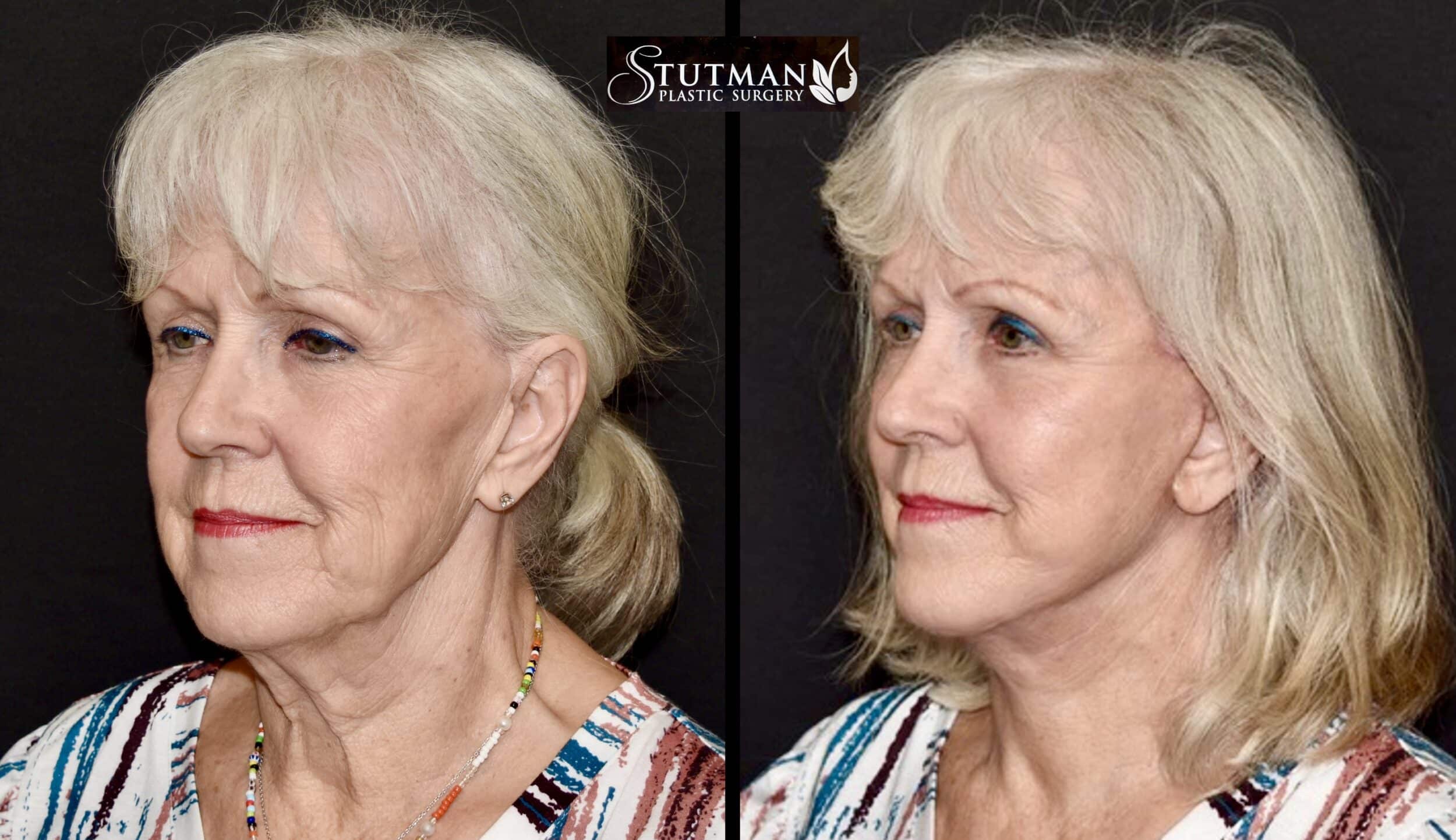 Before and After Image: Facelift/Necklift - left-front-oblique