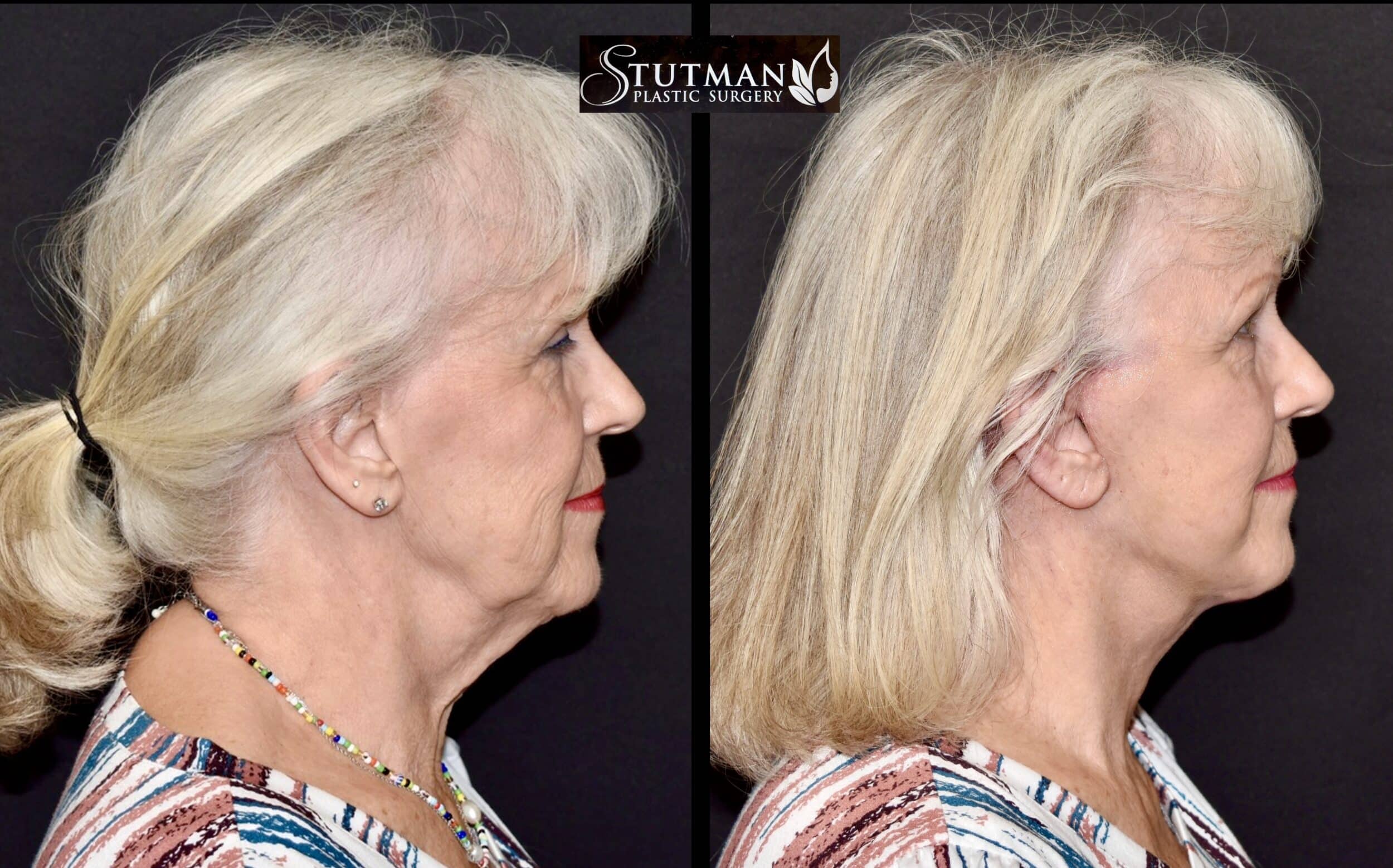 Before and After Image: Facelift/Necklift - right-side