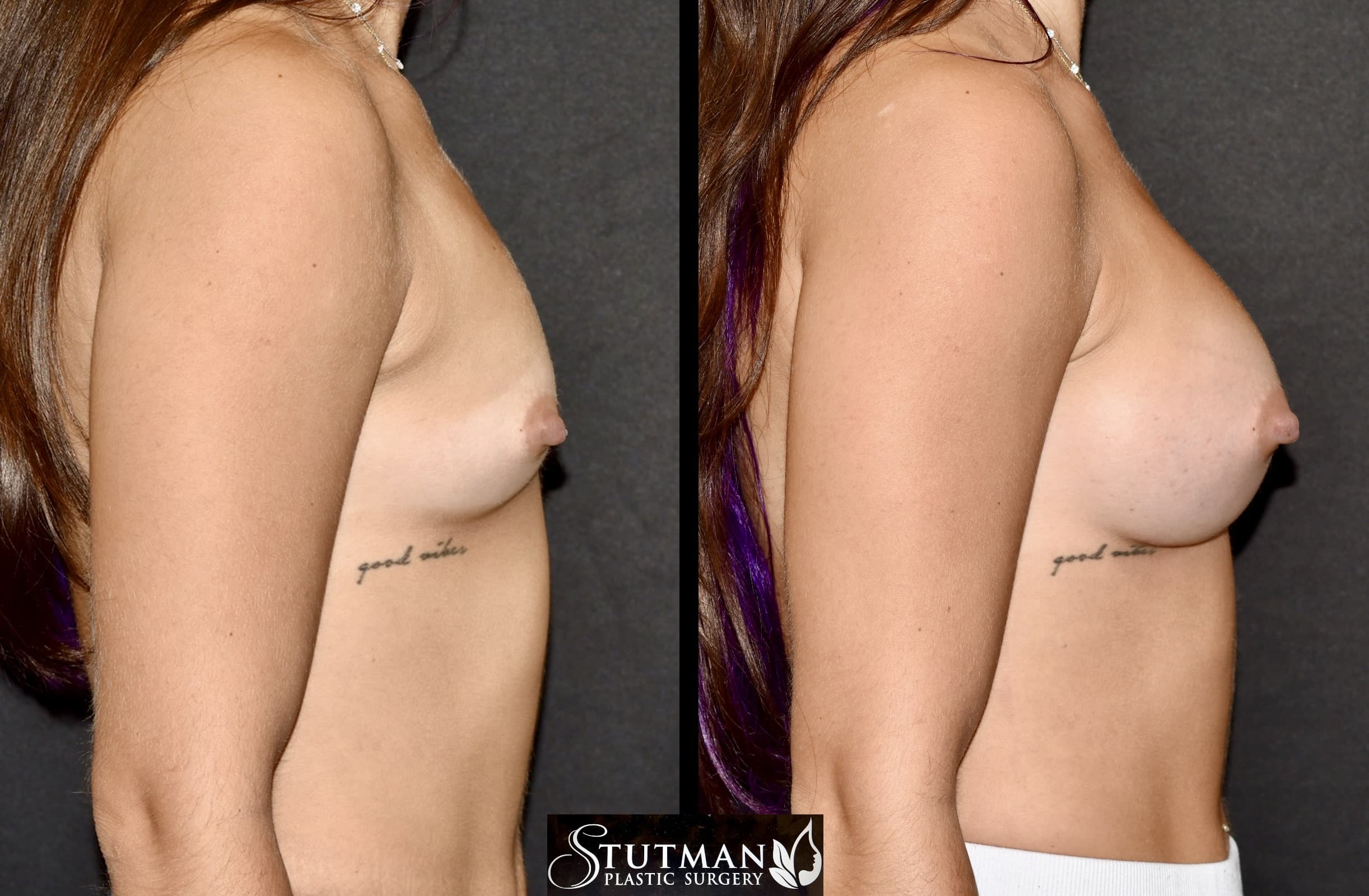 Before and After Image: Breast augmentation - right-side